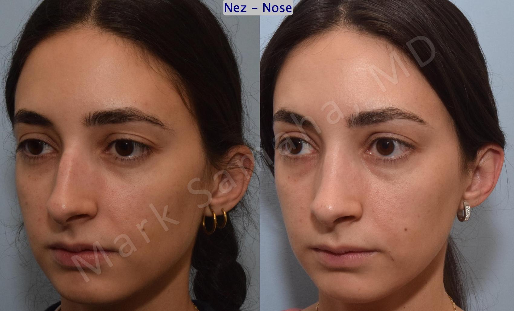 Before & After Rhinoplastie / Rhinoplasty Case 189 Left Oblique View in Montreal, QC