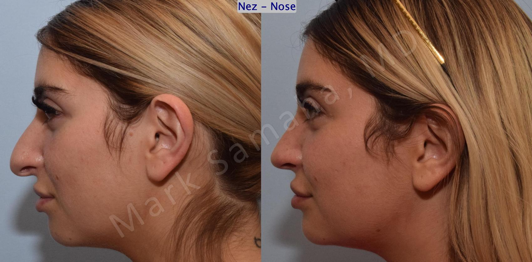 Before & After Rhinoplastie / Rhinoplasty Case 190 Left Side View in Montreal, QC
