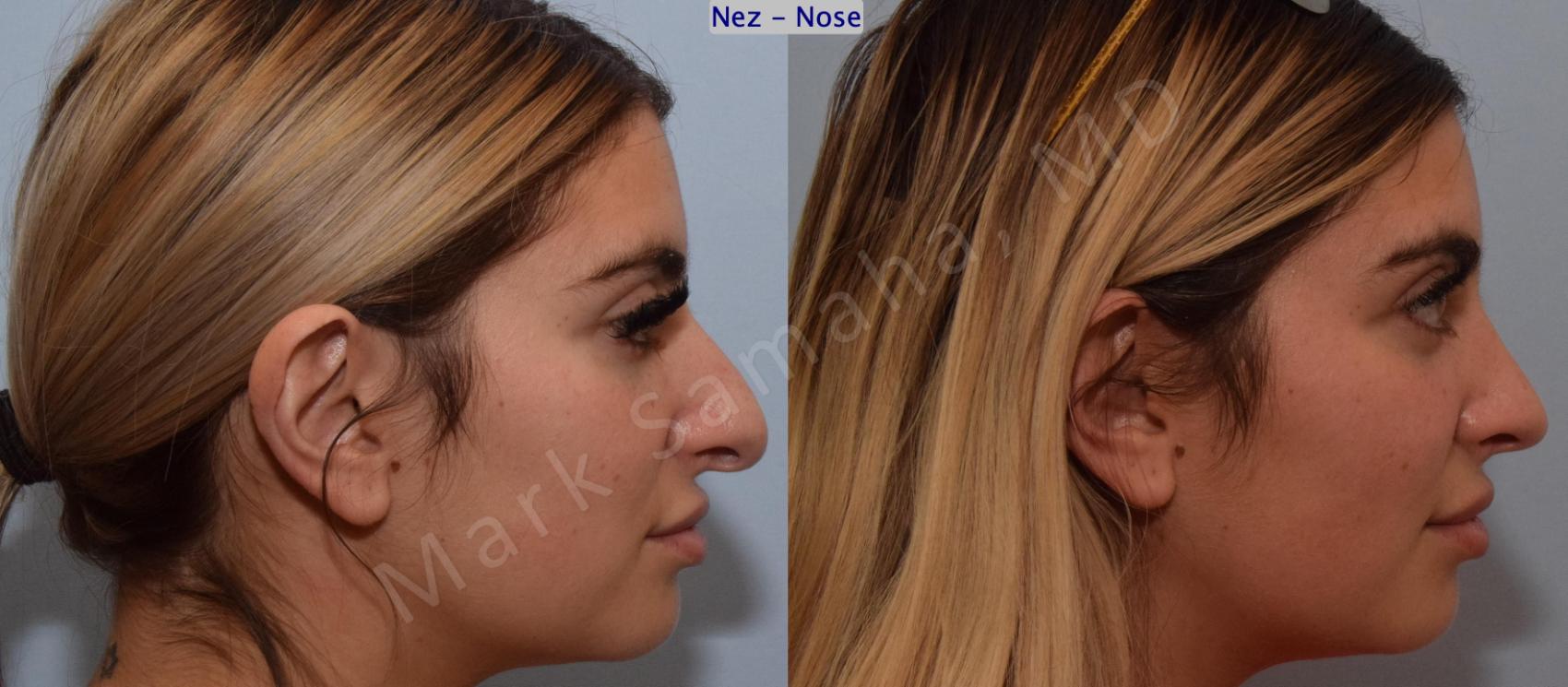 Before & After Rhinoplastie / Rhinoplasty Case 190 Right Side View in Montreal, QC