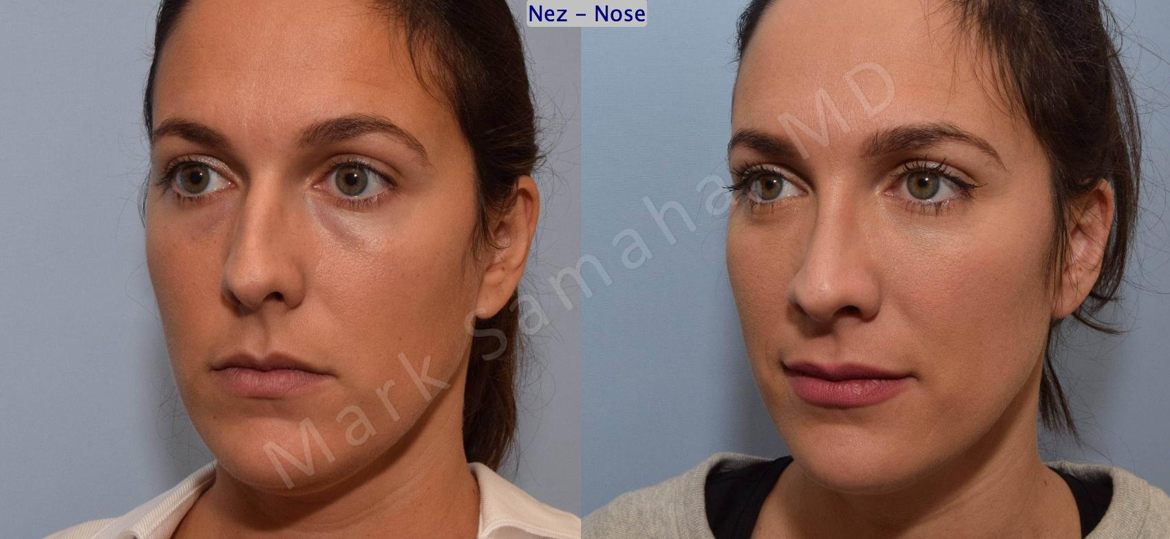 Before & After Rhinoplastie / Rhinoplasty Case 191 Left Oblique View in Montreal, QC