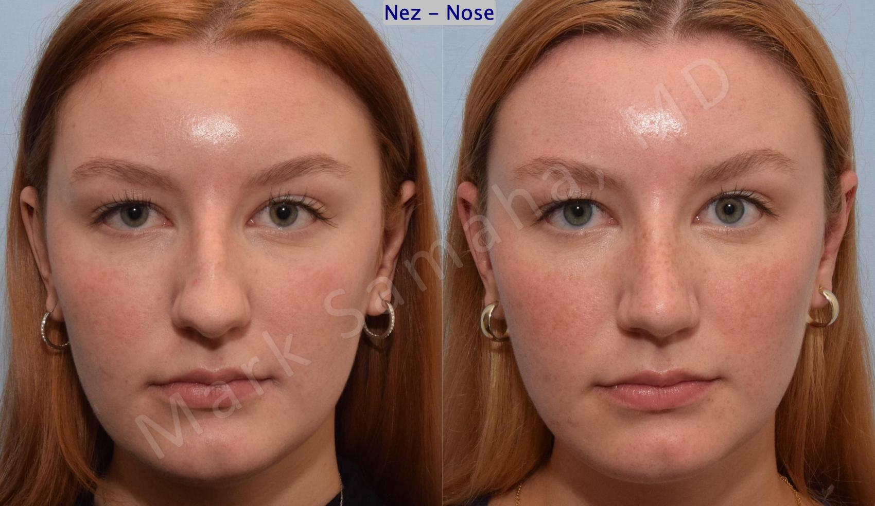 Before & After Rhinoplastie / Rhinoplasty Case 193 Front View in Montreal, QC