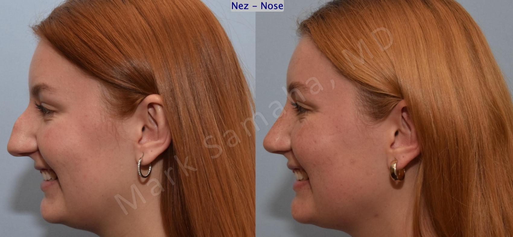 Before & After Rhinoplastie / Rhinoplasty Case 193 Left Side Smile View in Montreal, QC