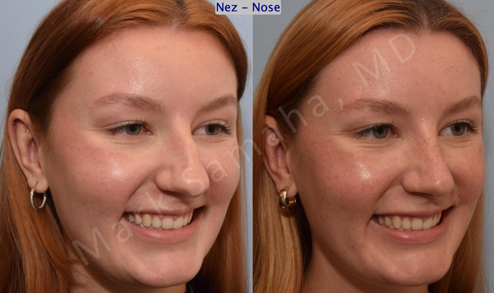 Before & After Rhinoplastie / Rhinoplasty Case 193 Right Oblique Smile View in Montreal, QC