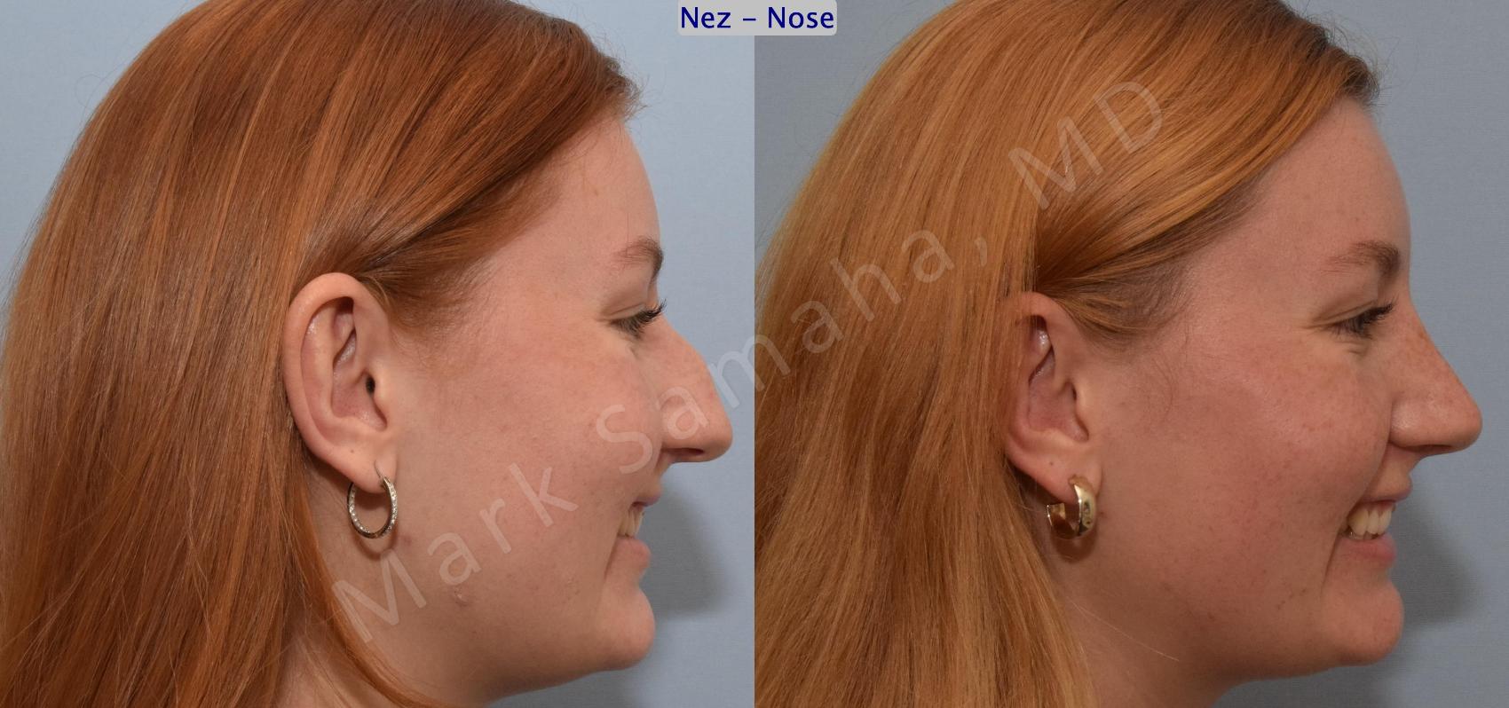 Before & After Rhinoplastie / Rhinoplasty Case 193 Right Side Smile View in Montreal, QC