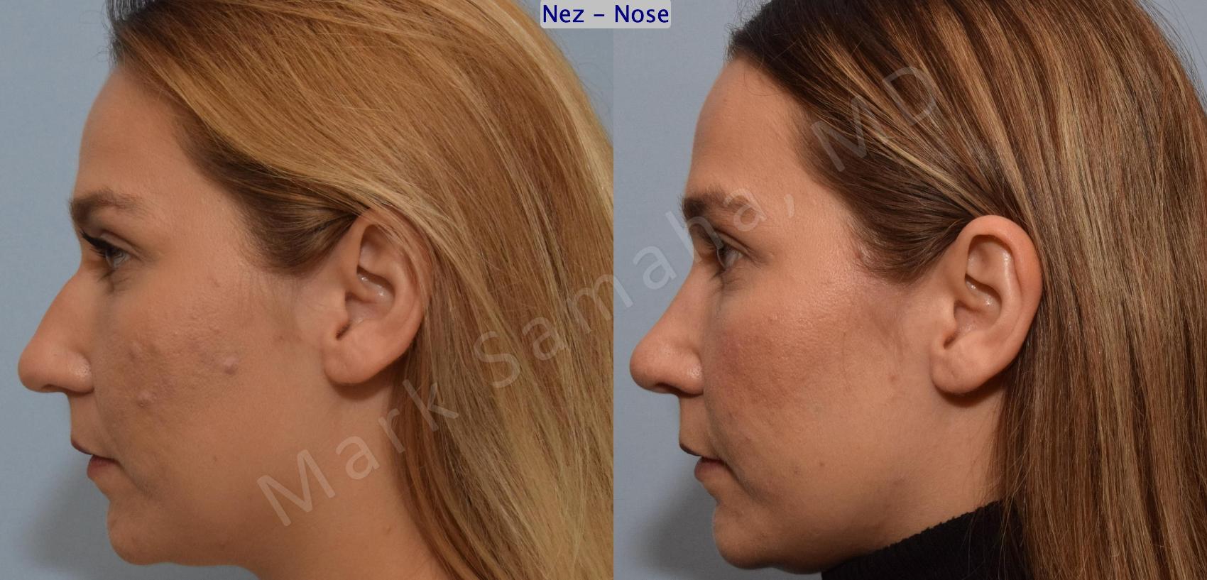 Before & After Rhinoplastie / Rhinoplasty Case 194 Left Side View in Montreal, QC
