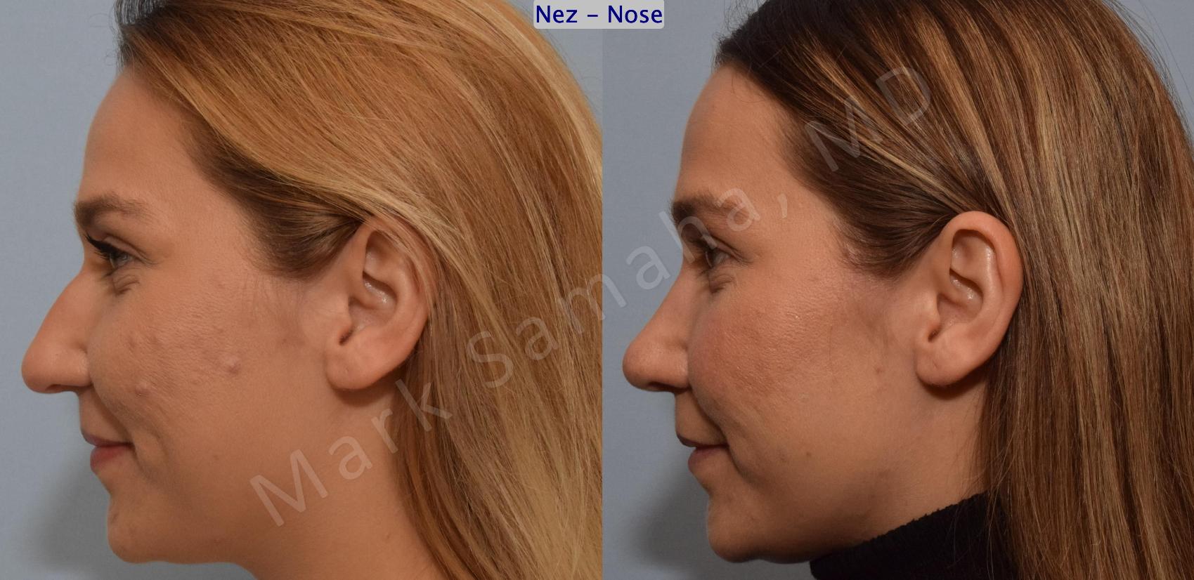 Before & After Rhinoplastie / Rhinoplasty Case 194 Left Side Smile View in Montreal, QC