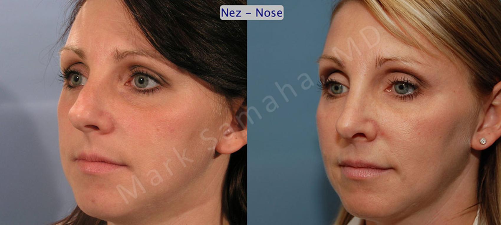 Before & After Rhinoplastie / Rhinoplasty Case 33 View #2 View in Montreal, QC