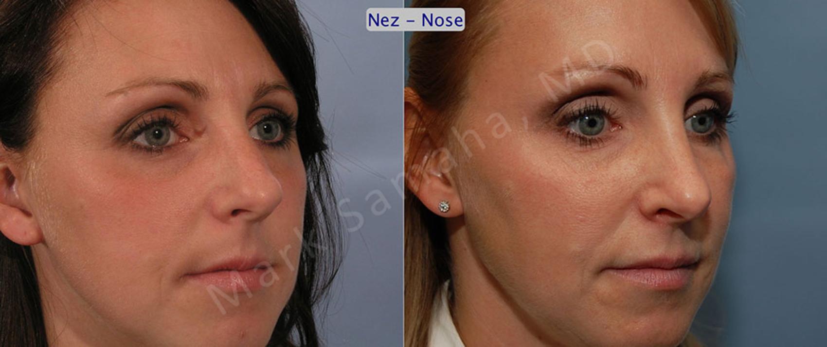 Before & After Rhinoplastie / Rhinoplasty Case 33 View #3 View in Montreal, QC