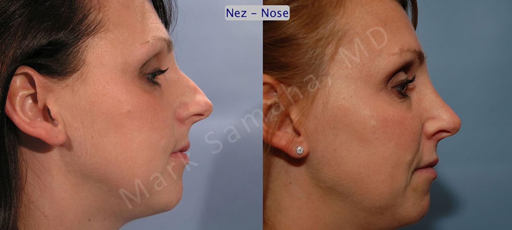 Before & After Rhinoplastie / Rhinoplasty Case 33 View #4 View in Montreal, QC