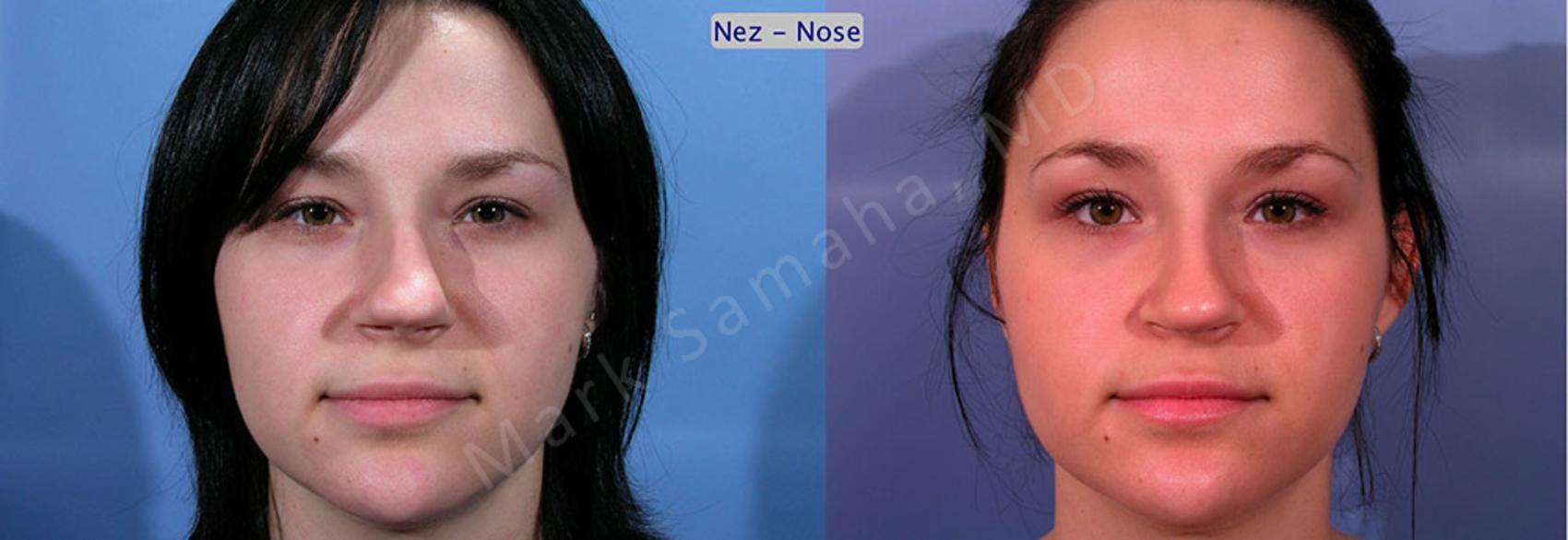 Before & After Rhinoplastie / Rhinoplasty Case 35 View #1 View in Montreal, QC