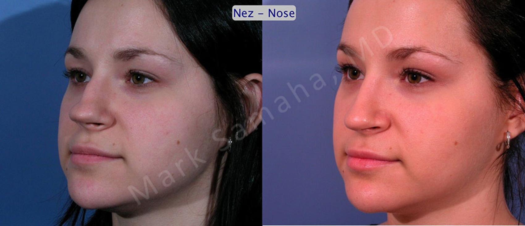 Before & After Rhinoplastie / Rhinoplasty Case 35 View #3 View in Montreal, QC