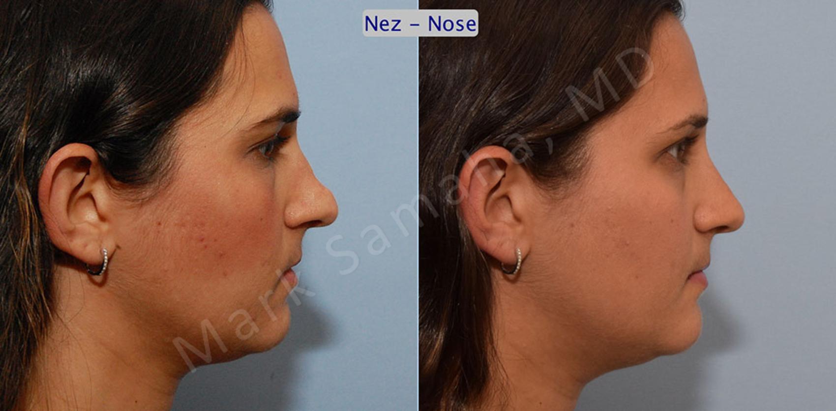 Before & After Rhinoplastie / Rhinoplasty Case 37 View #2 View in Montreal, QC