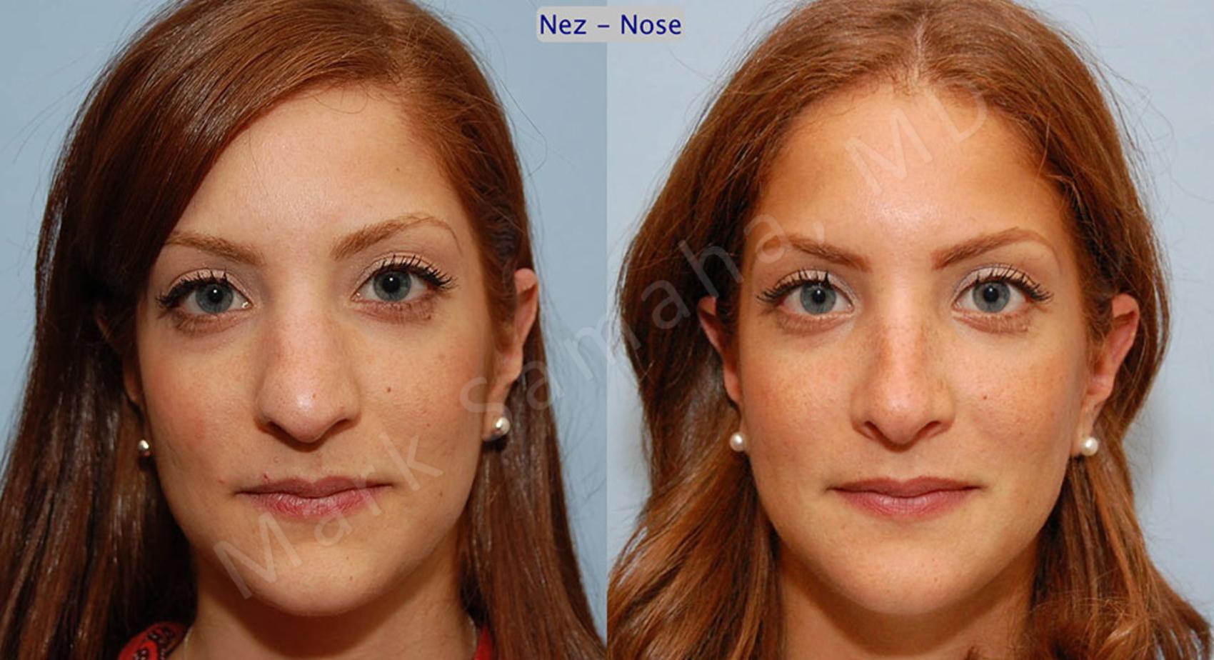 Before & After Rhinoplastie / Rhinoplasty Case 43 View #1 View in Montreal, QC