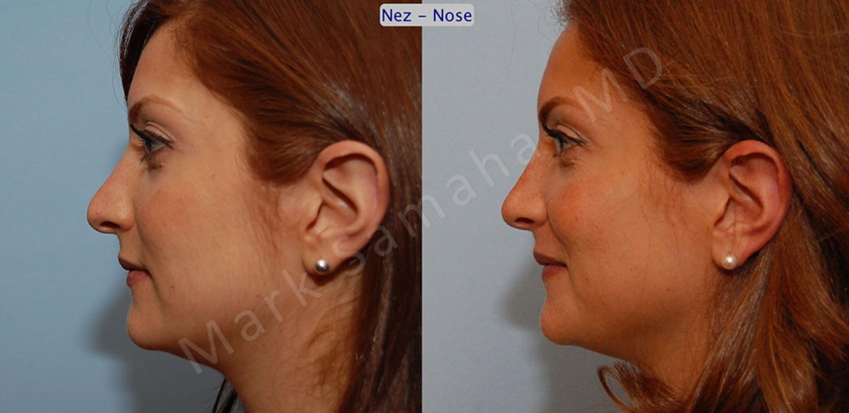 Before & After Rhinoplastie / Rhinoplasty Case 43 View #2 View in Montreal, QC