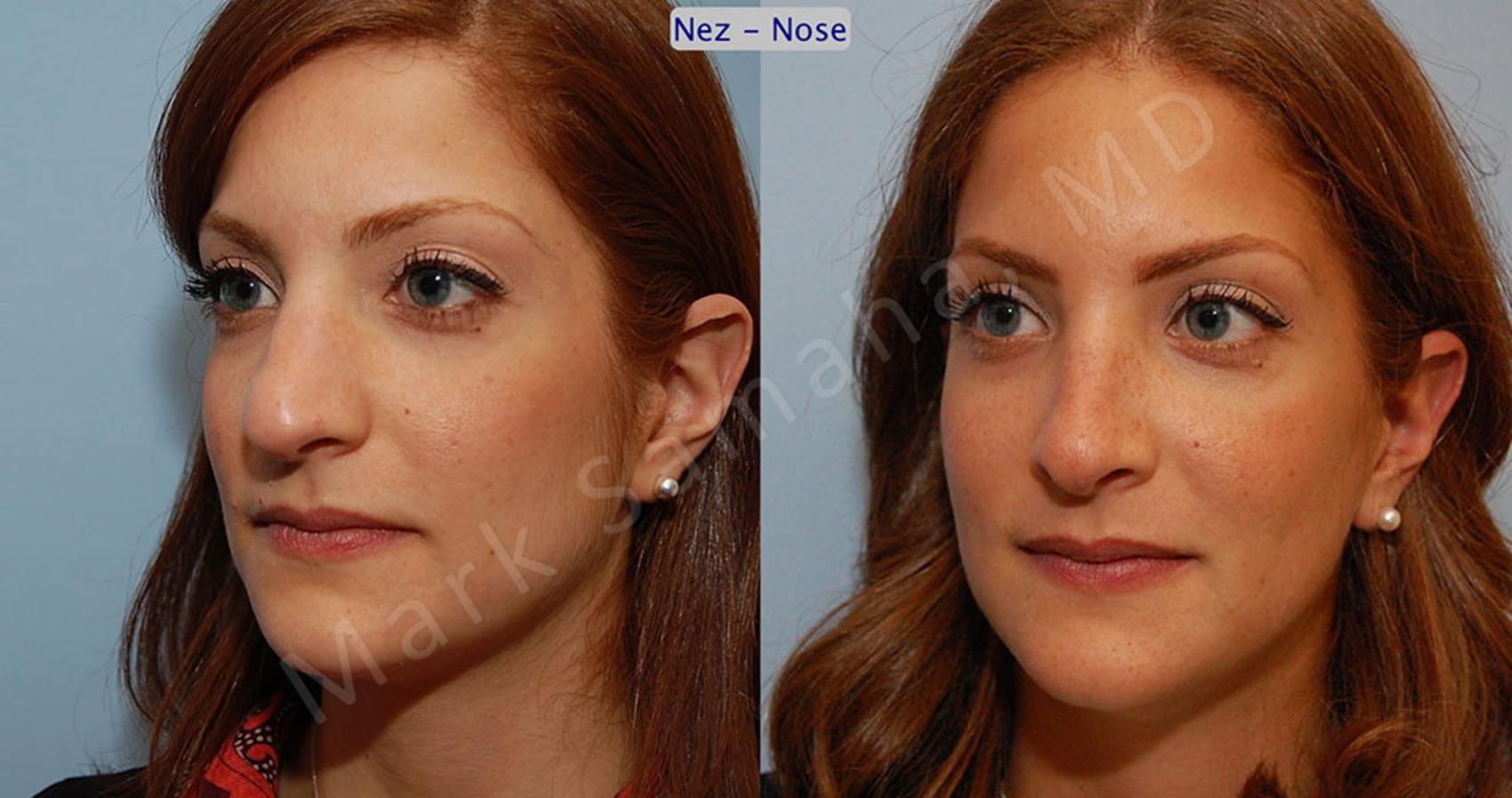 Before & After Rhinoplastie / Rhinoplasty Case 43 View #3 View in Montreal, QC