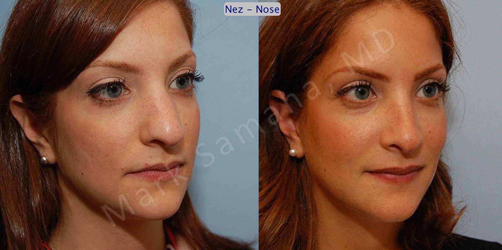 Before & After Rhinoplastie / Rhinoplasty Case 43 View #4 View in Montreal, QC