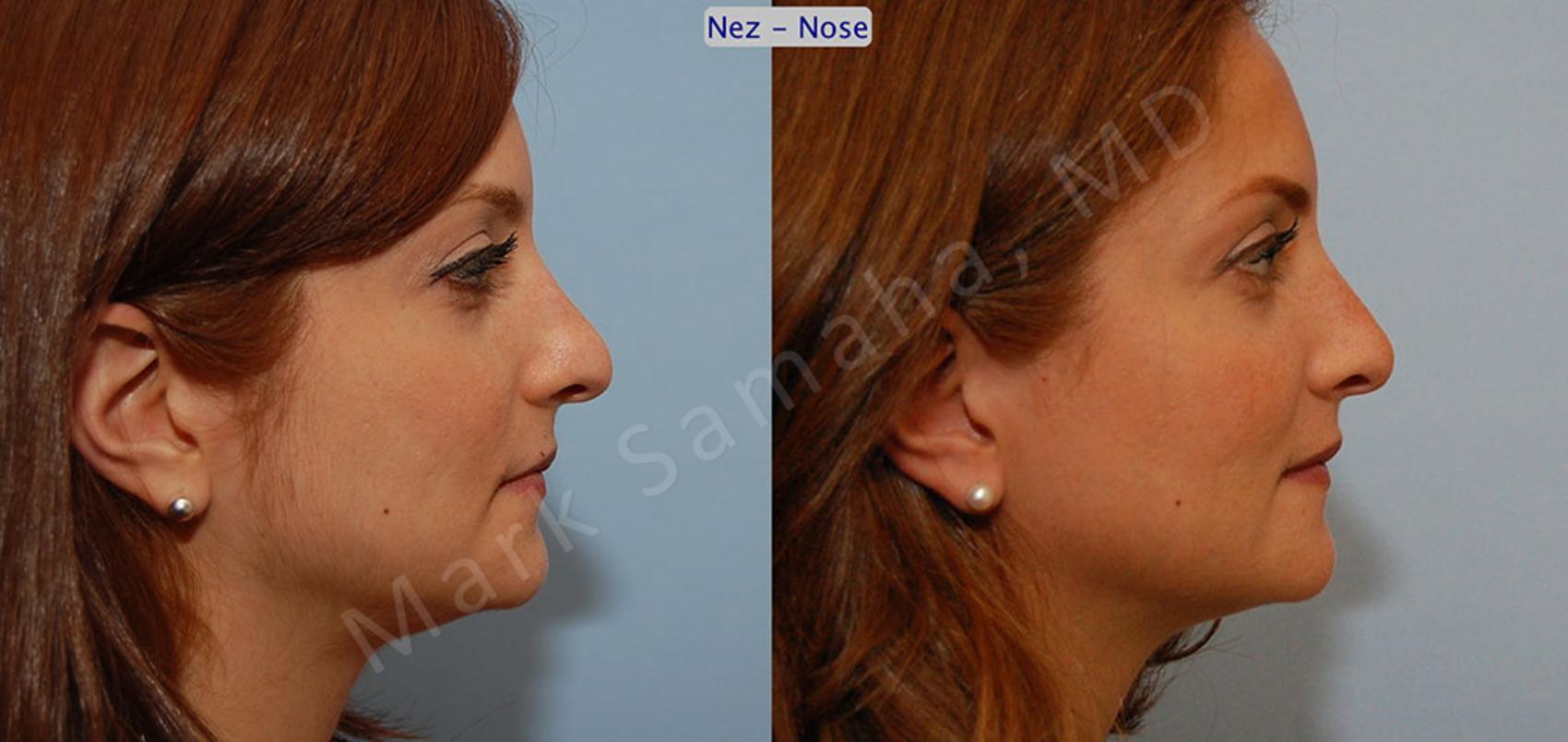 Before & After Rhinoplastie / Rhinoplasty Case 43 View #5 View in Montreal, QC