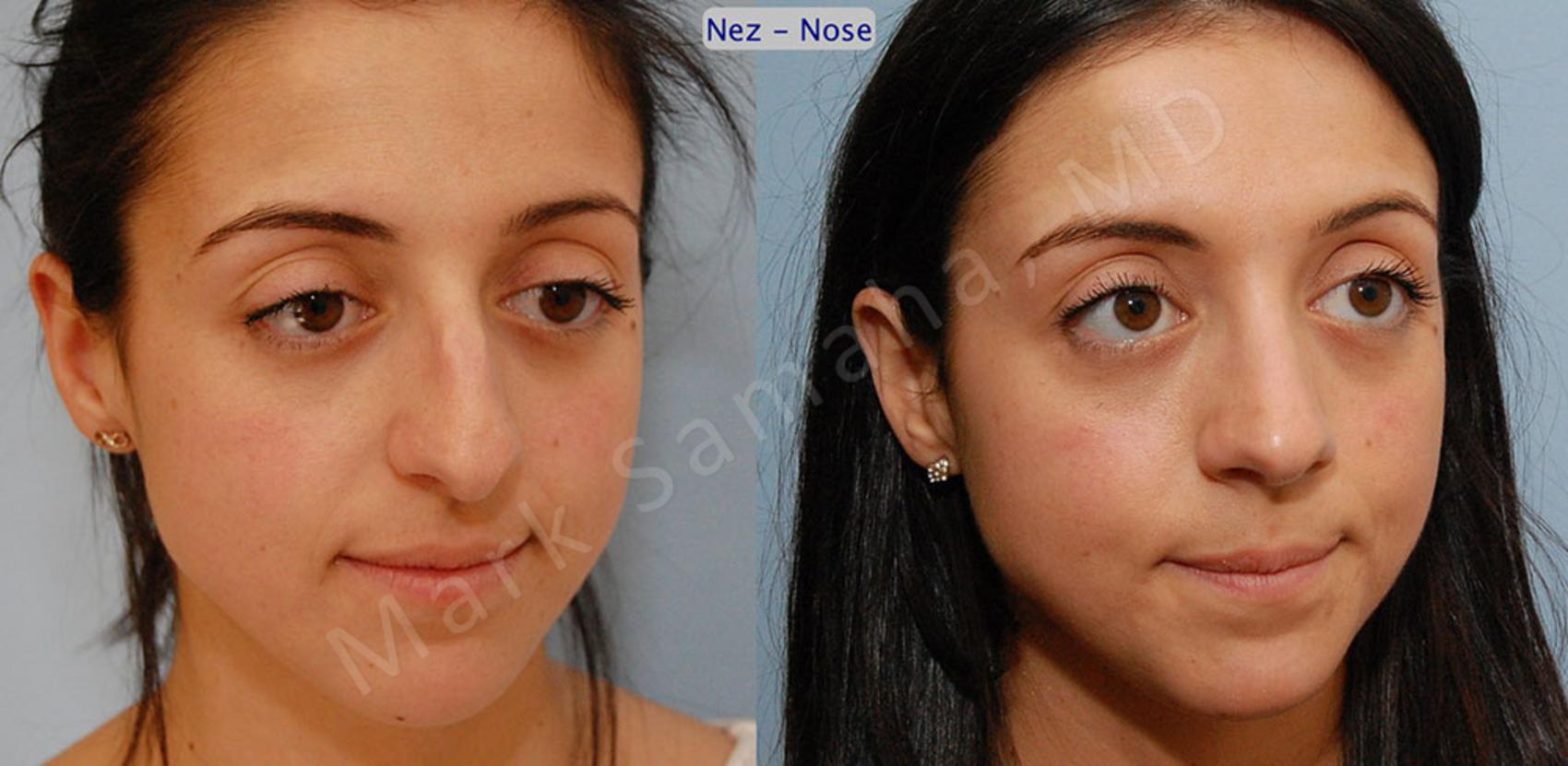 Before & After Rhinoplastie / Rhinoplasty Case 47 View #4 View in Montreal, QC