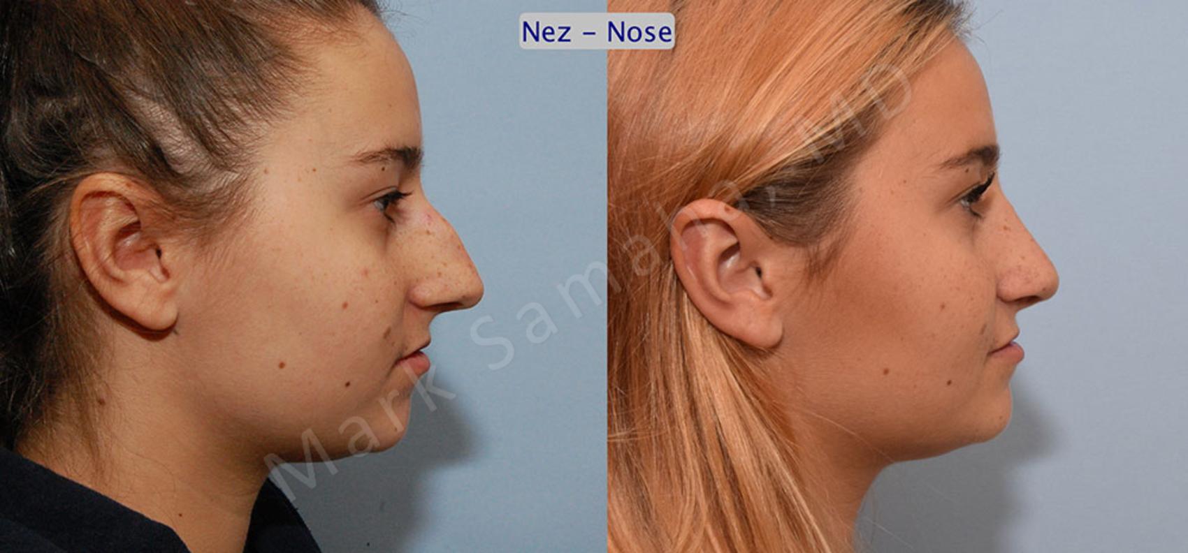 Before & After Rhinoplastie / Rhinoplasty Case 50 View #4 View in Montreal, QC