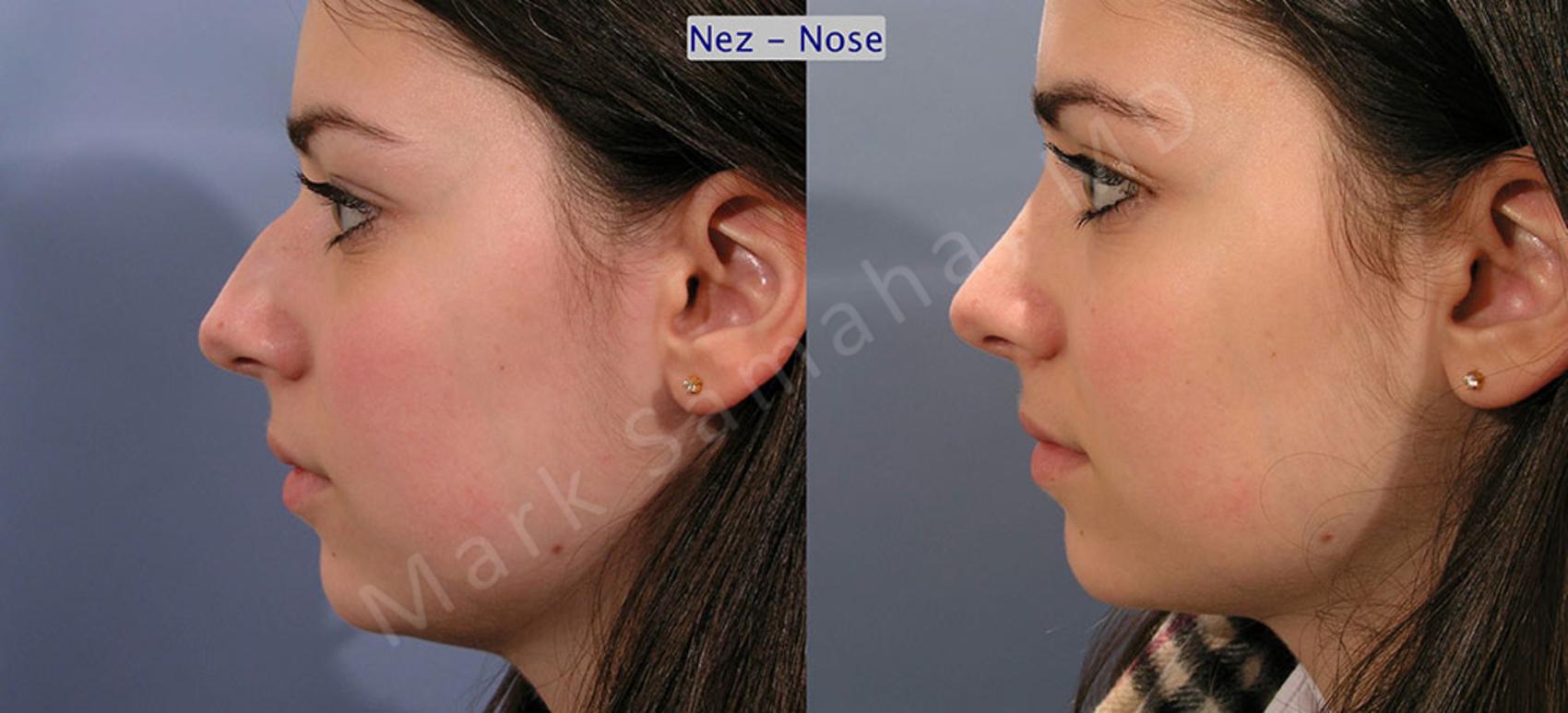 Before & After Rhinoplastie / Rhinoplasty Case 52 View #1 View in Montreal, QC
