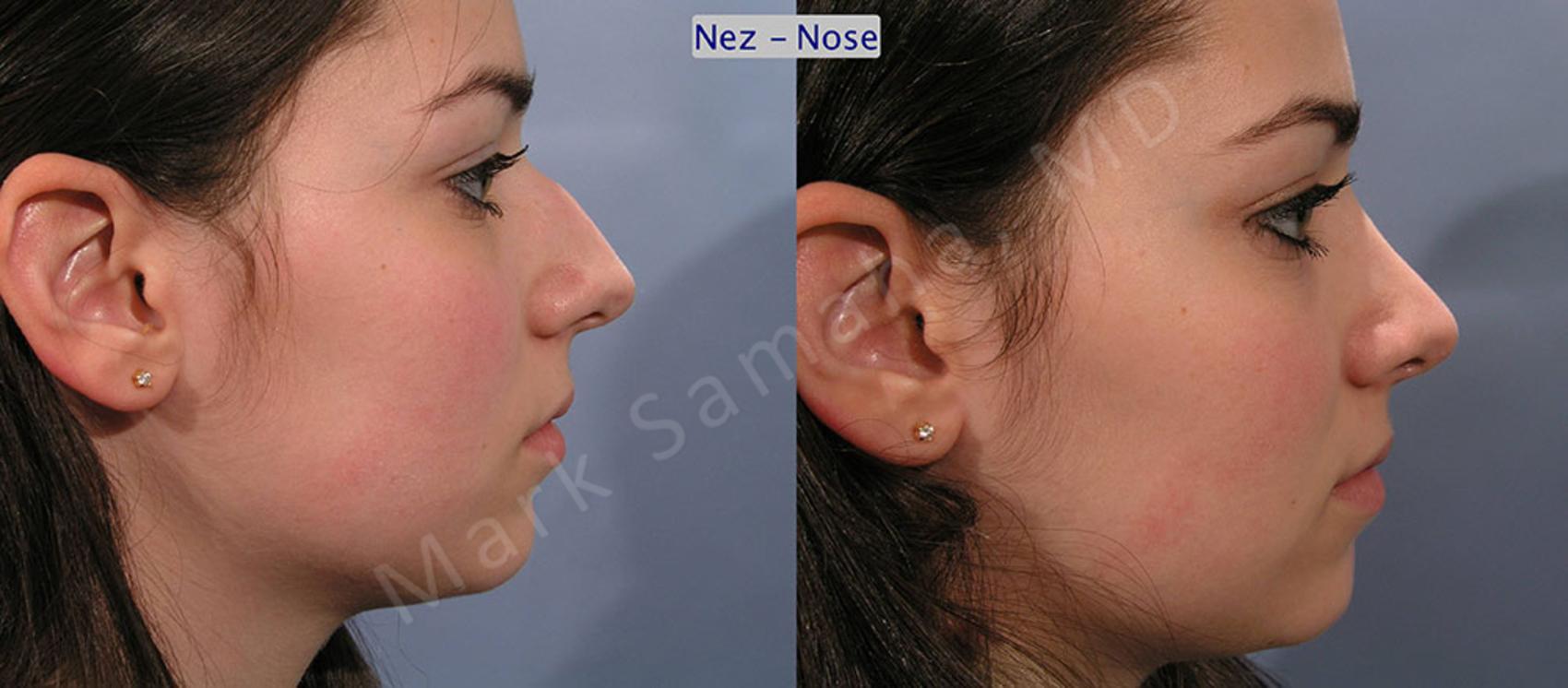 Before & After Rhinoplastie / Rhinoplasty Case 52 View #2 View in Montreal, QC