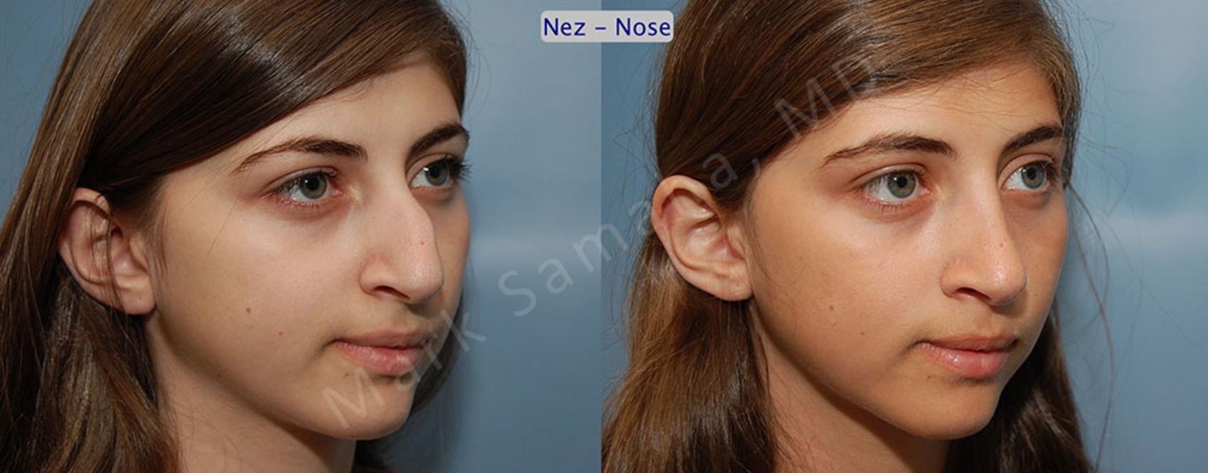 Before & After Rhinoplastie / Rhinoplasty Case 55 View #3 View in Montreal, QC