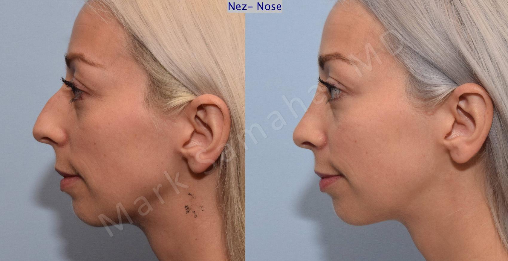 Before & After Rhinoplastie / Rhinoplasty Case 77 View #1 View in Montreal, QC