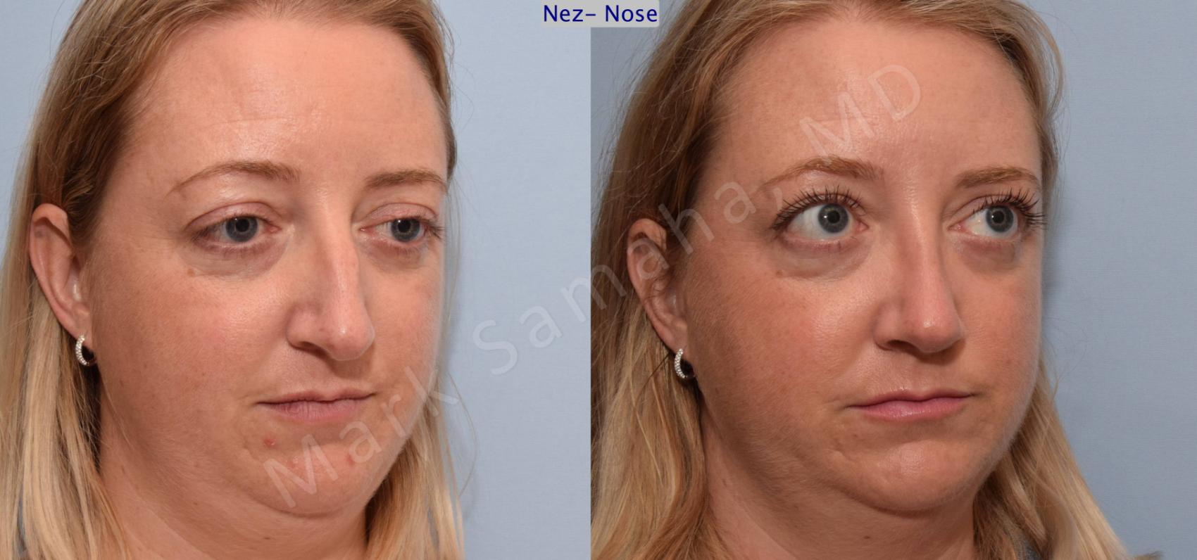 Before & After Rhinoplastie / Rhinoplasty Case 78 View #3 View in Montreal, QC