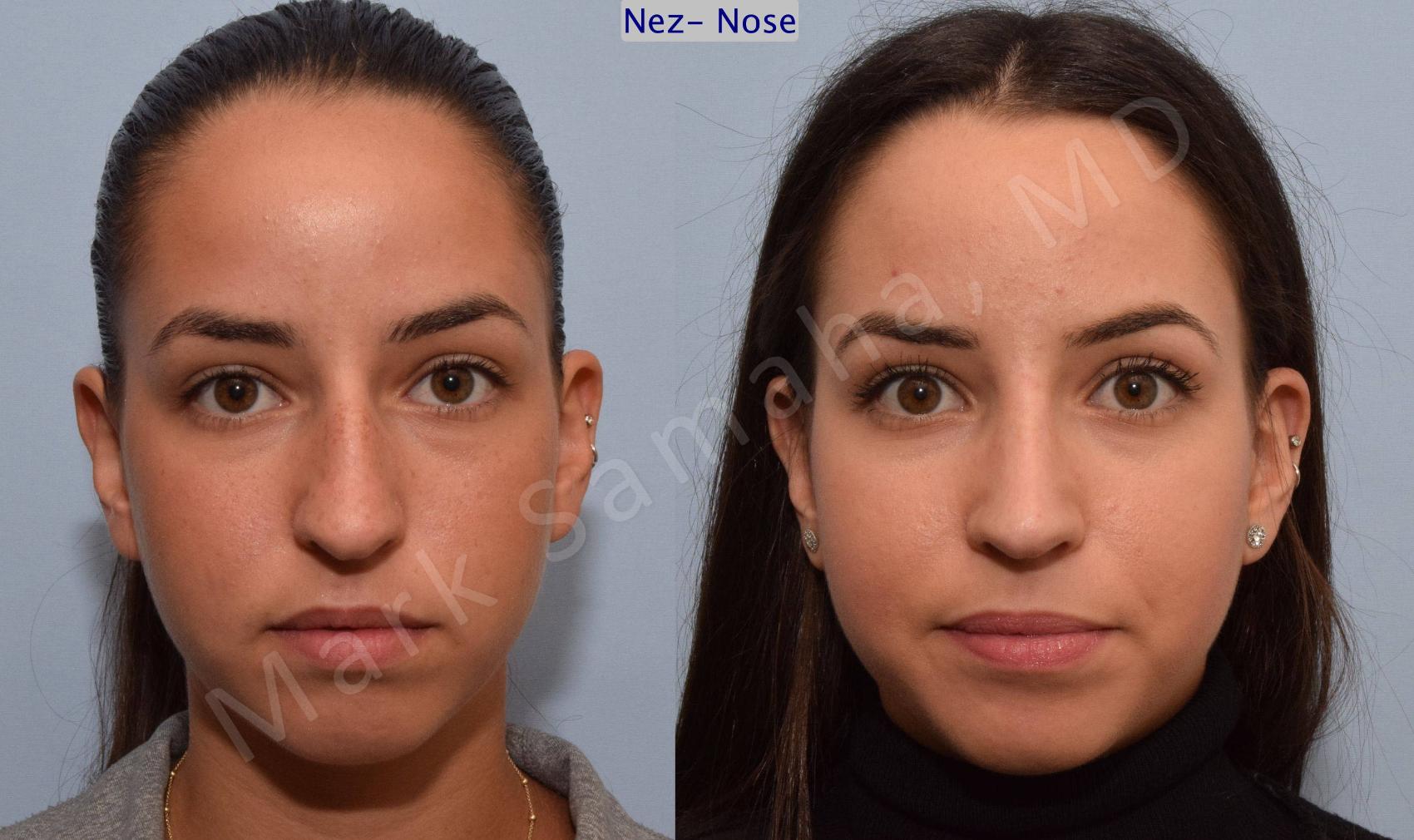 Before & After Rhinoplastie / Rhinoplasty Case 80 View #1 View in Montreal, QC
