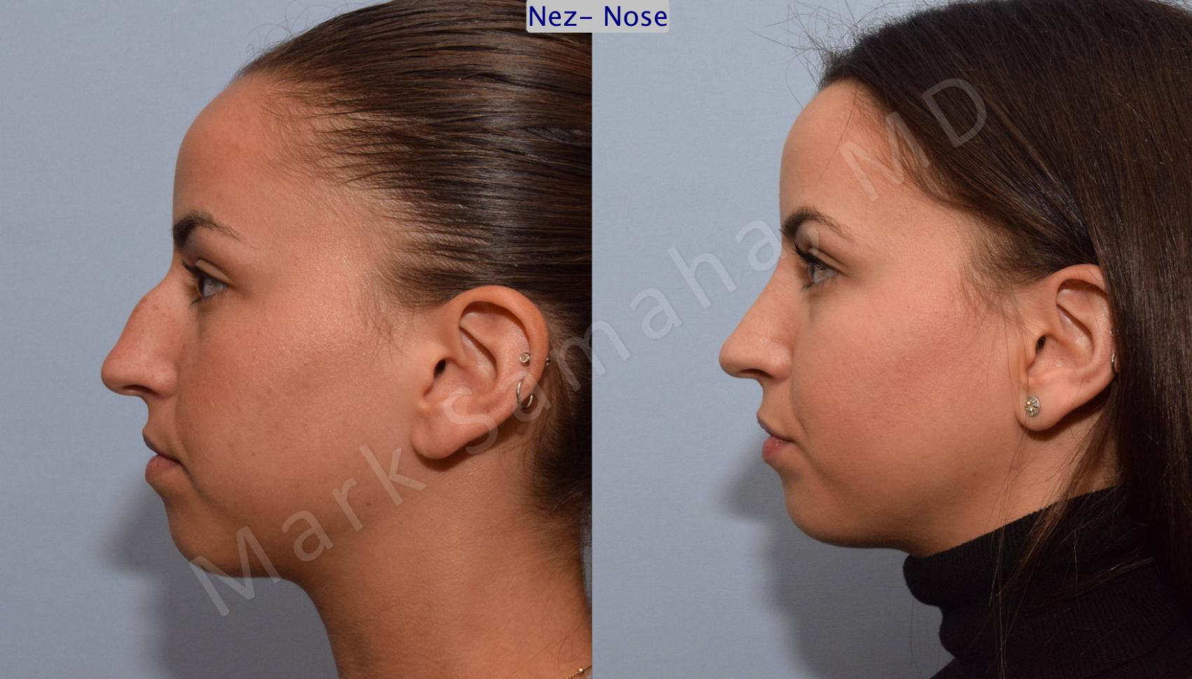 Before & After Rhinoplastie / Rhinoplasty Case 80 View #2 View in Montreal, QC