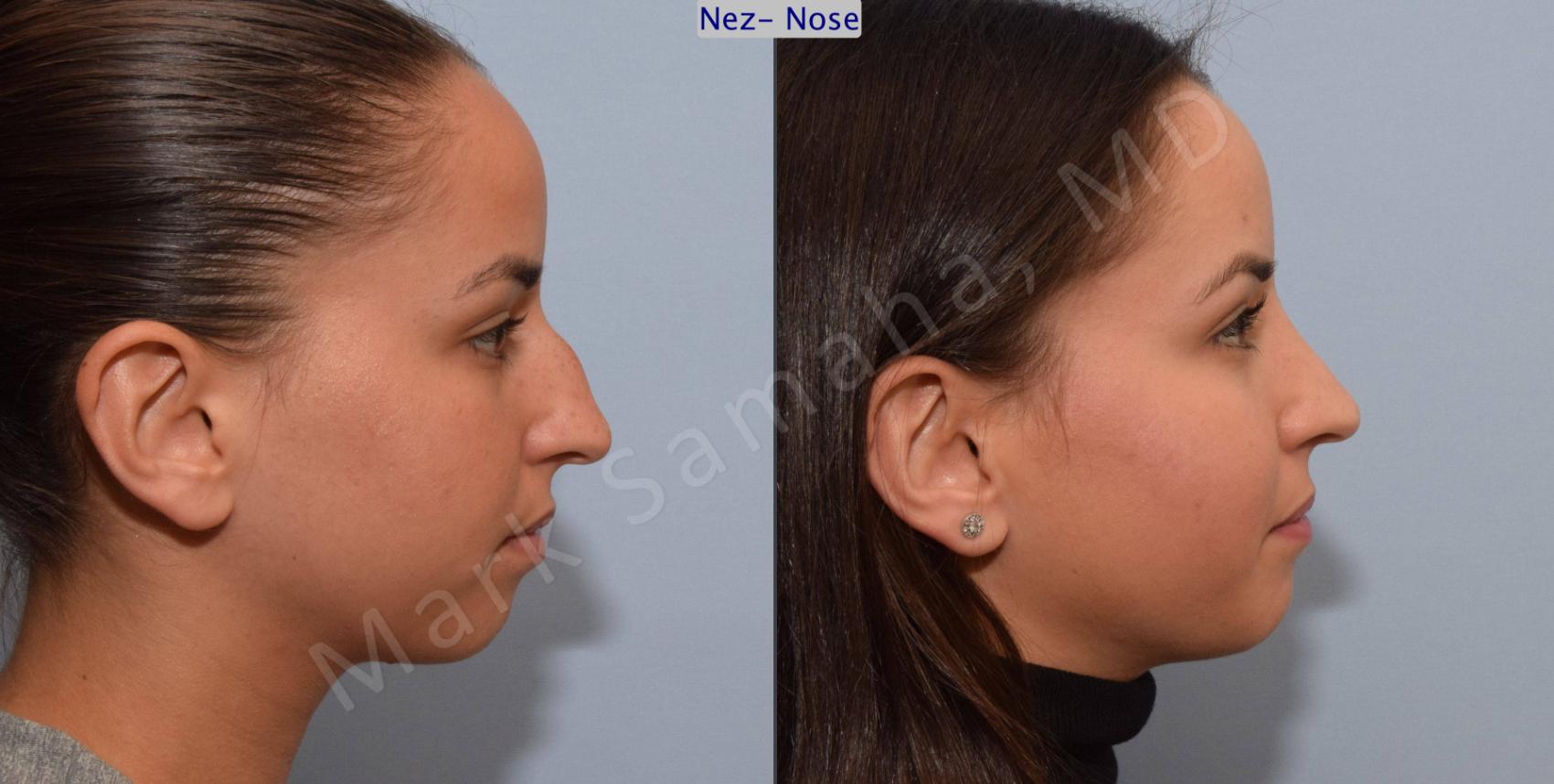 Before & After Rhinoplastie / Rhinoplasty Case 80 View #3 View in Montreal, QC