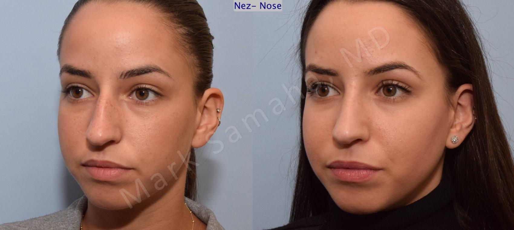 Before & After Rhinoplastie / Rhinoplasty Case 80 View #4 View in Montreal, QC