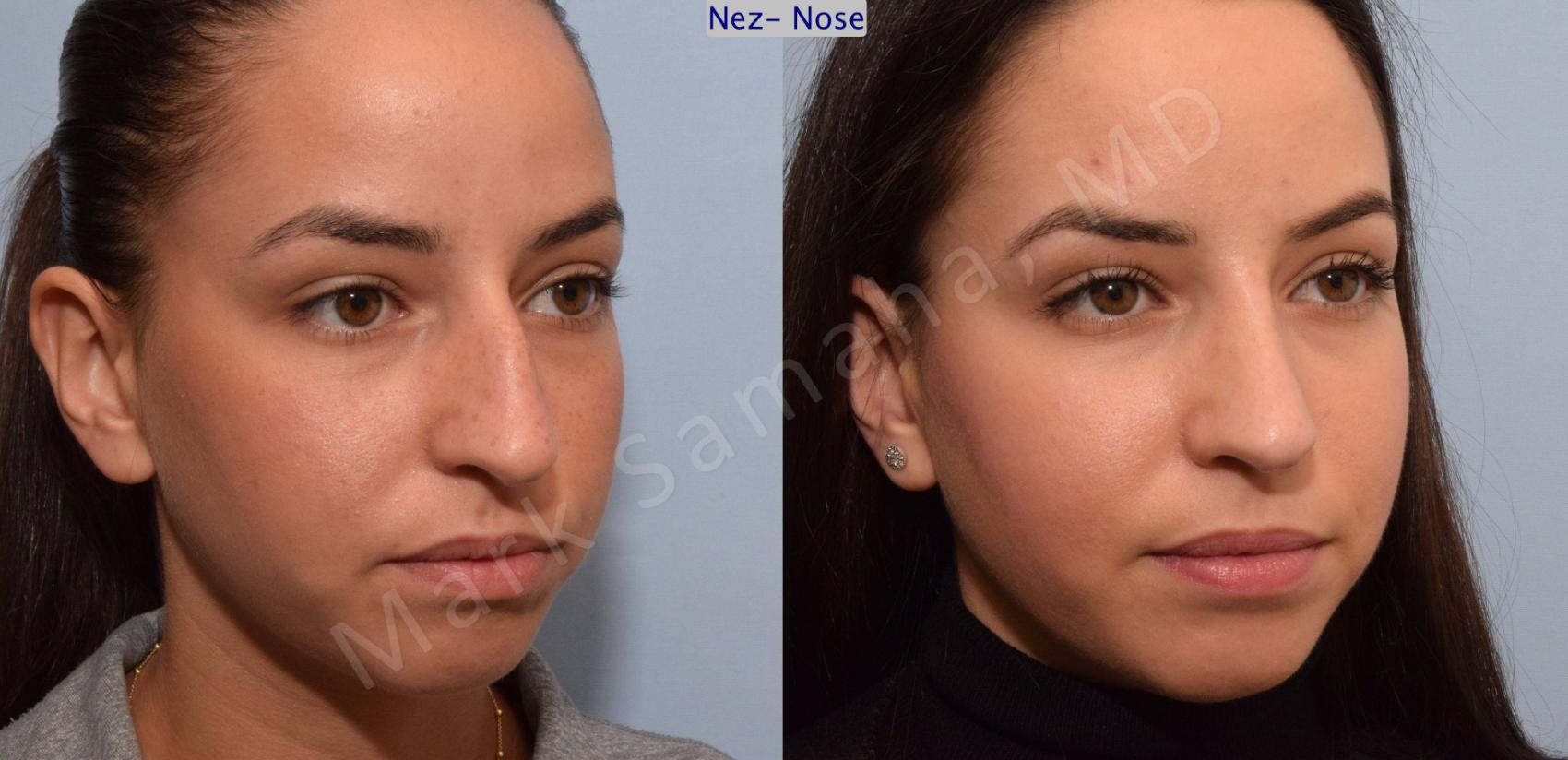 Before & After Rhinoplastie / Rhinoplasty Case 80 View #5 View in Montreal, QC