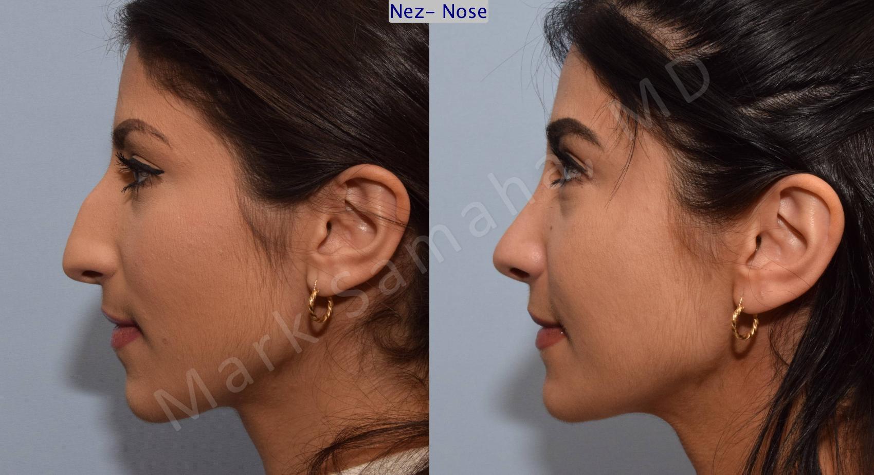 Before & After Rhinoplastie / Rhinoplasty Case 83 View #1 View in Montreal, QC