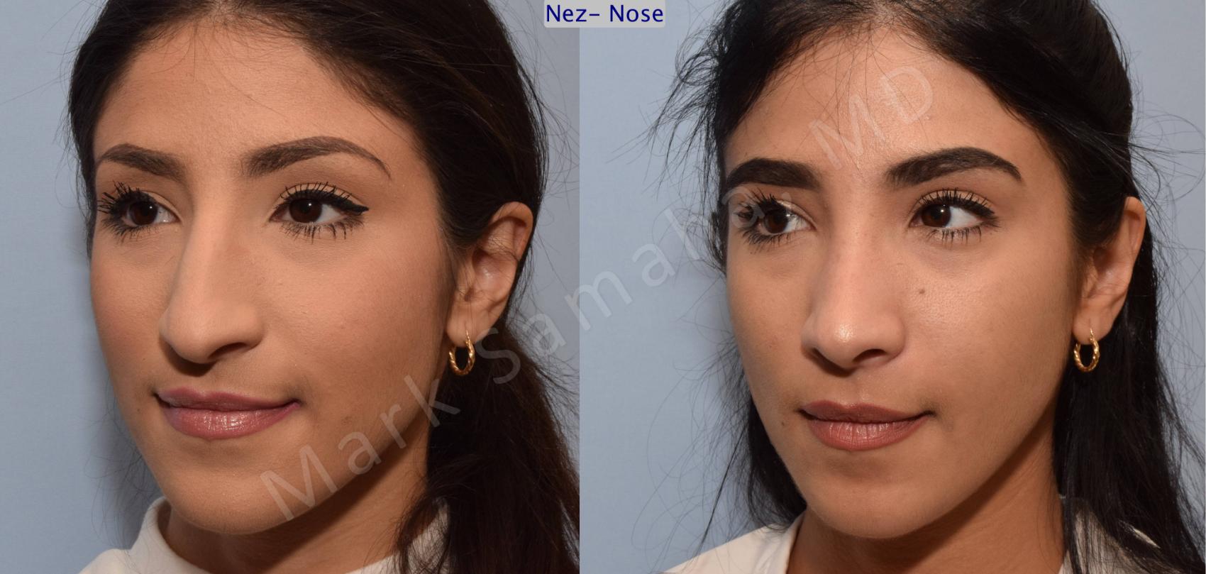Before & After Rhinoplastie / Rhinoplasty Case 83 View #3 View in Montreal, QC