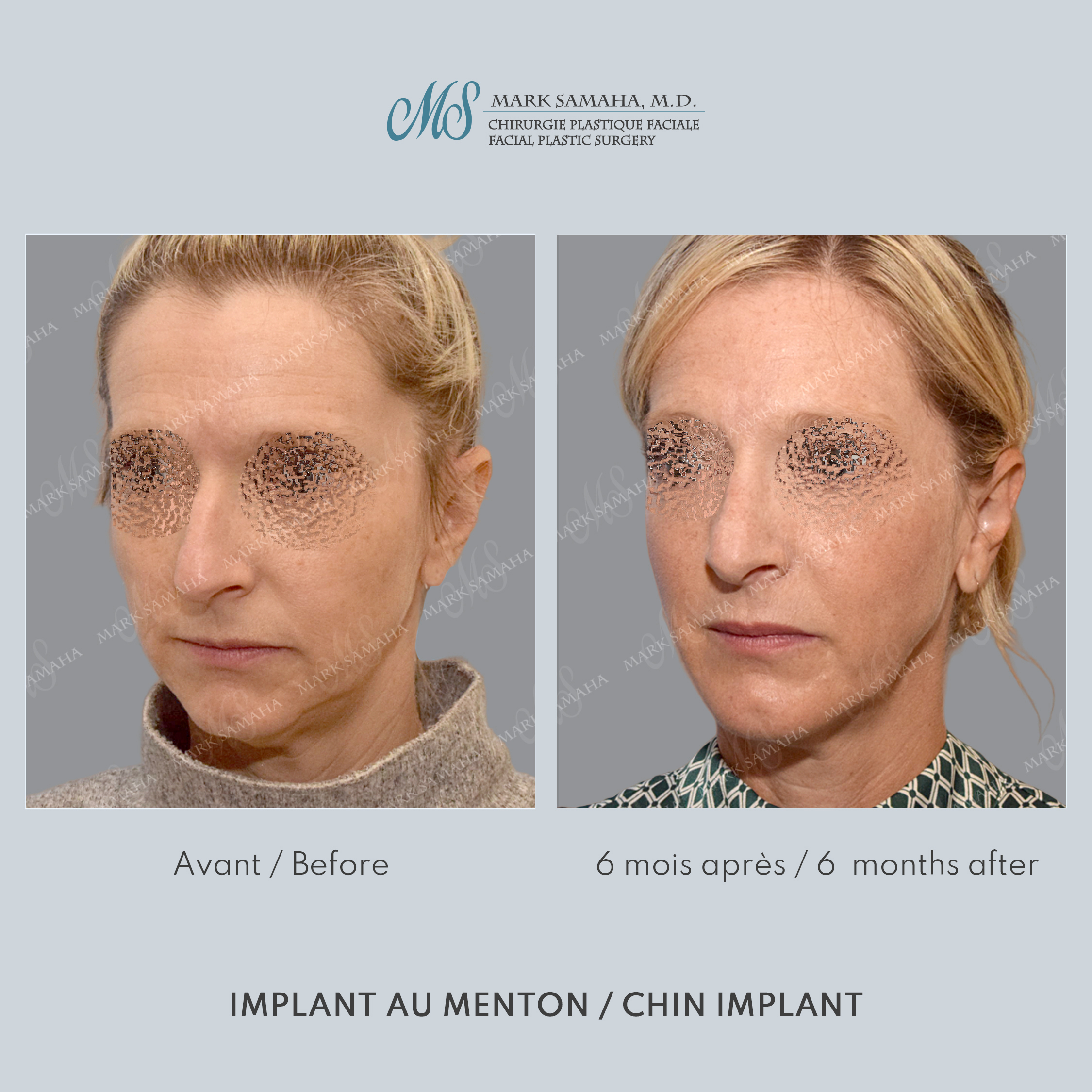 Before & After Augmentation du menton / Chin Augmentation Case 231 View #1 Detail View in Montreal, QC