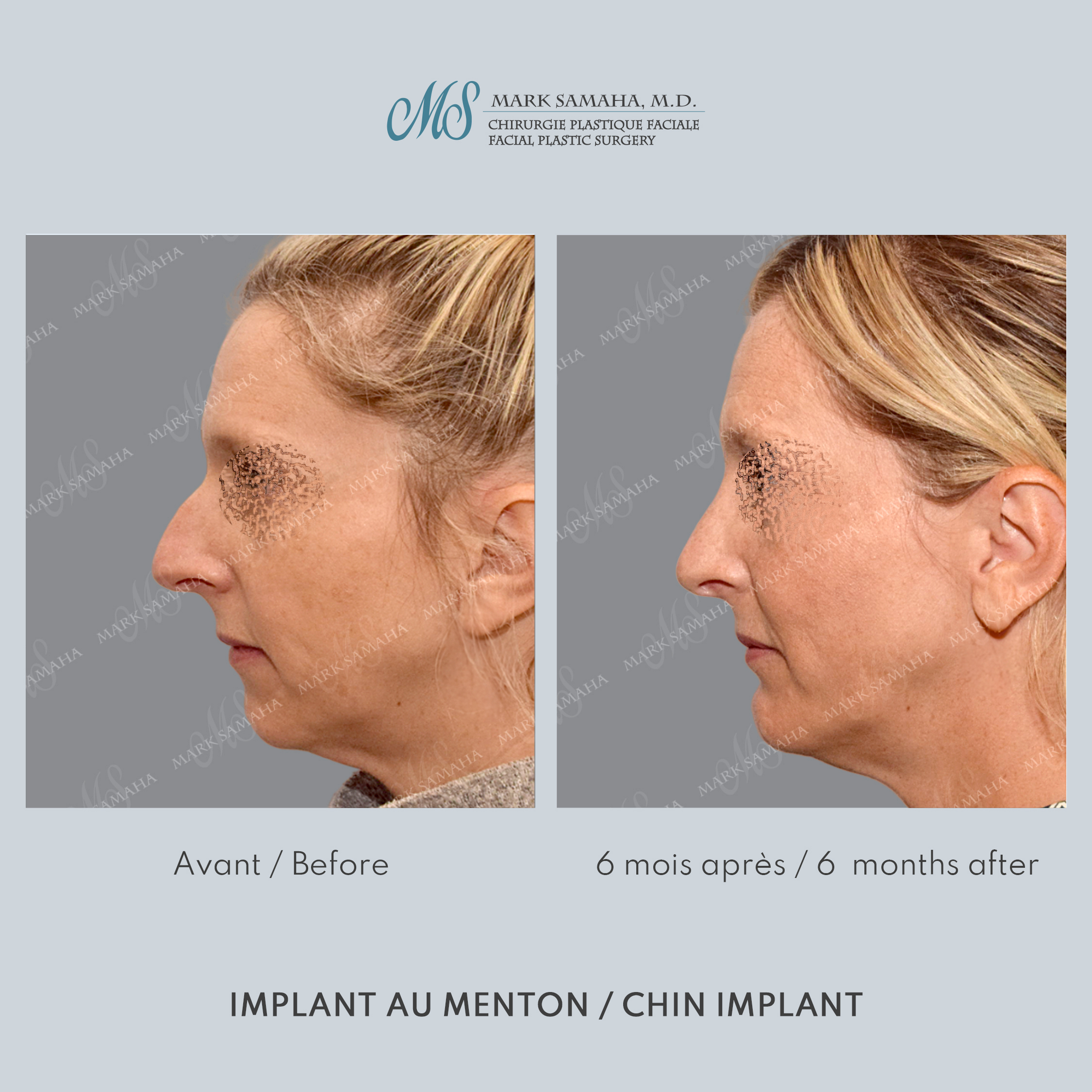 Before & After Augmentation du menton / Chin Augmentation Case 231 View #2 Detail View in Montreal, QC