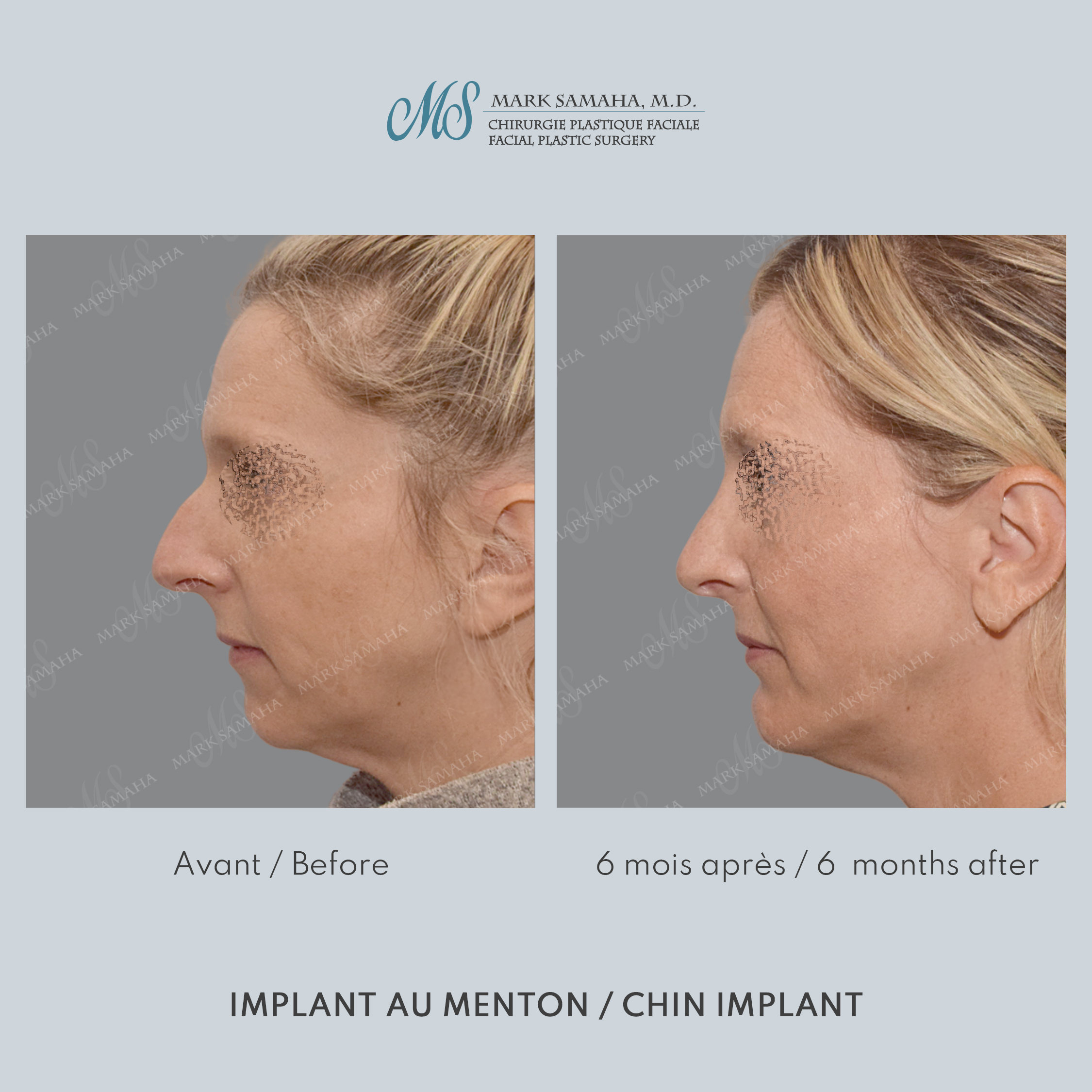 Before & After Augmentation du menton / Chin Augmentation Case 231 View #2 View in Montreal, QC