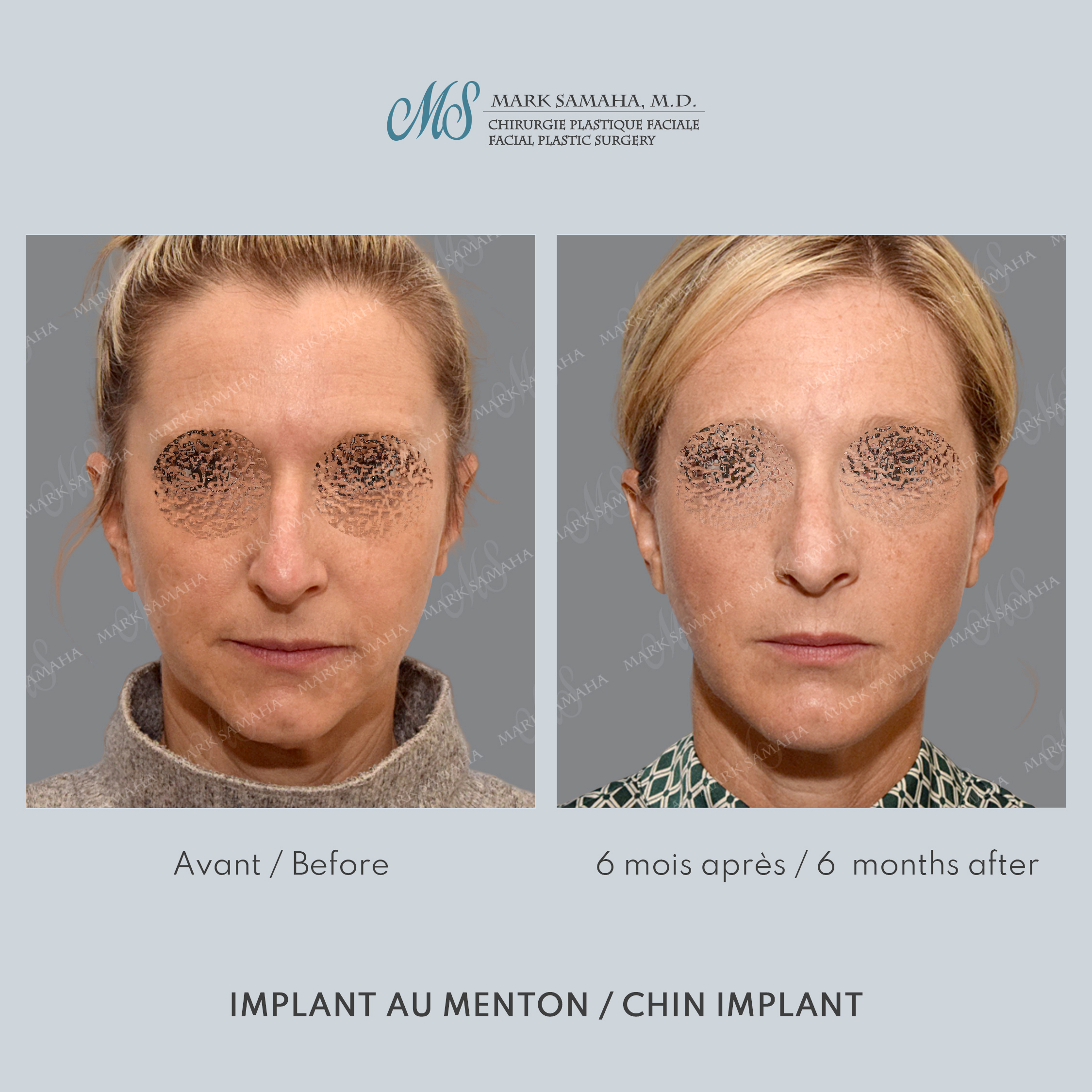 Before & After Augmentation du menton / Chin Augmentation Case 231 View #3 Detail View in Montreal, QC