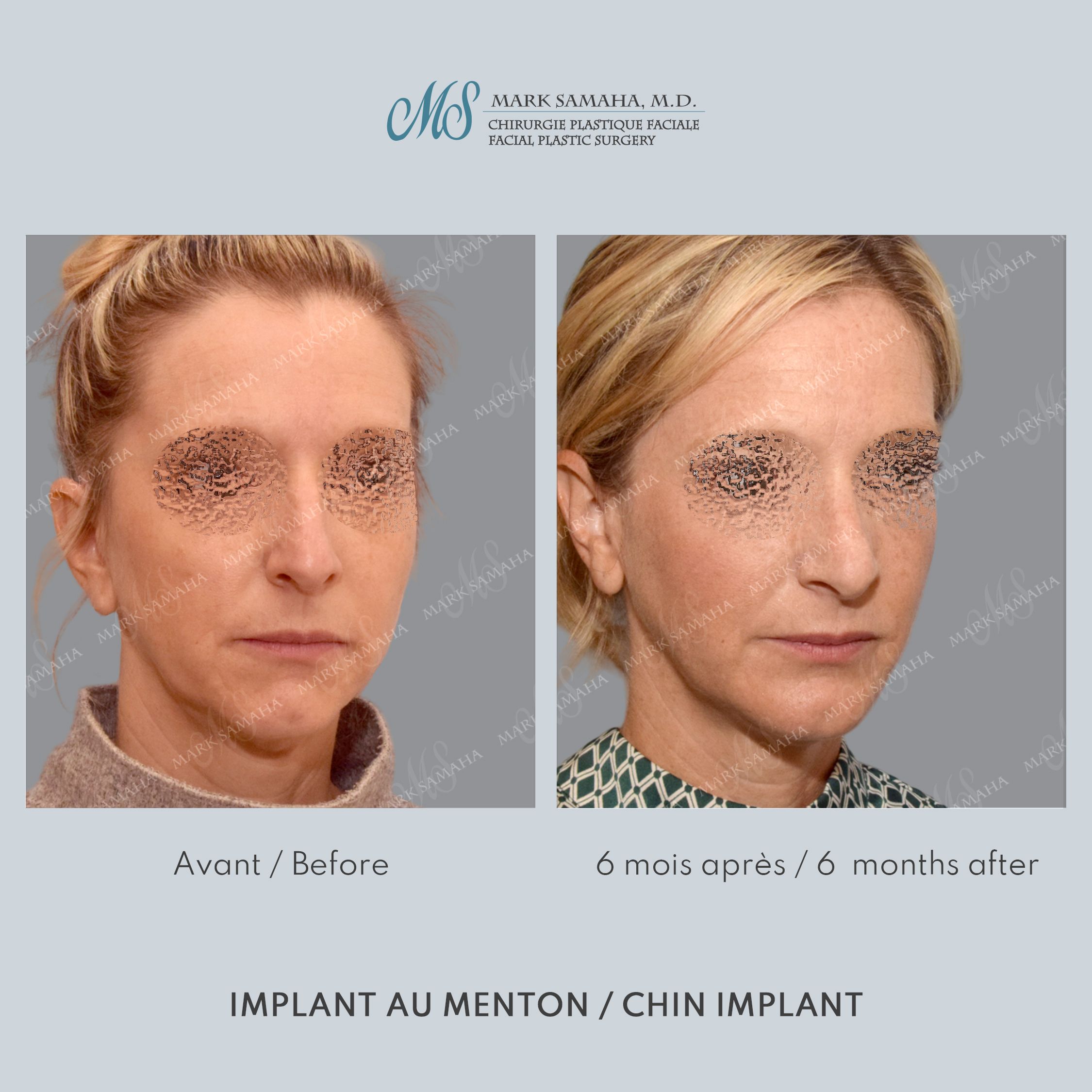Before & After Augmentation du menton / Chin Augmentation Case 231 View #4 Detail View in Montreal, QC