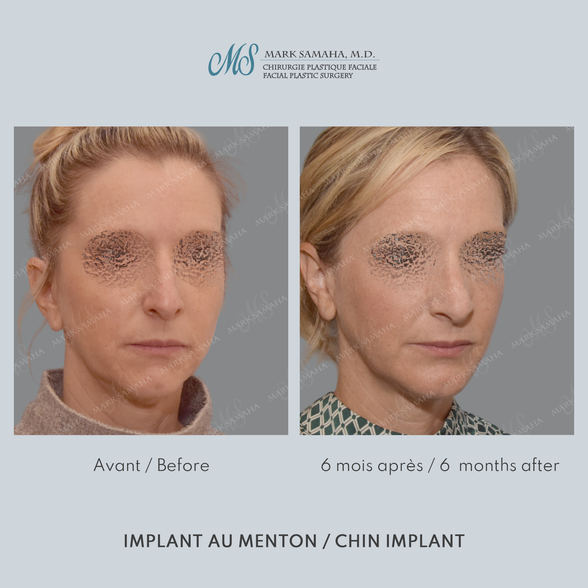 Before & After Augmentation du menton / Chin Augmentation Case 231 View #4 View in Montreal, QC