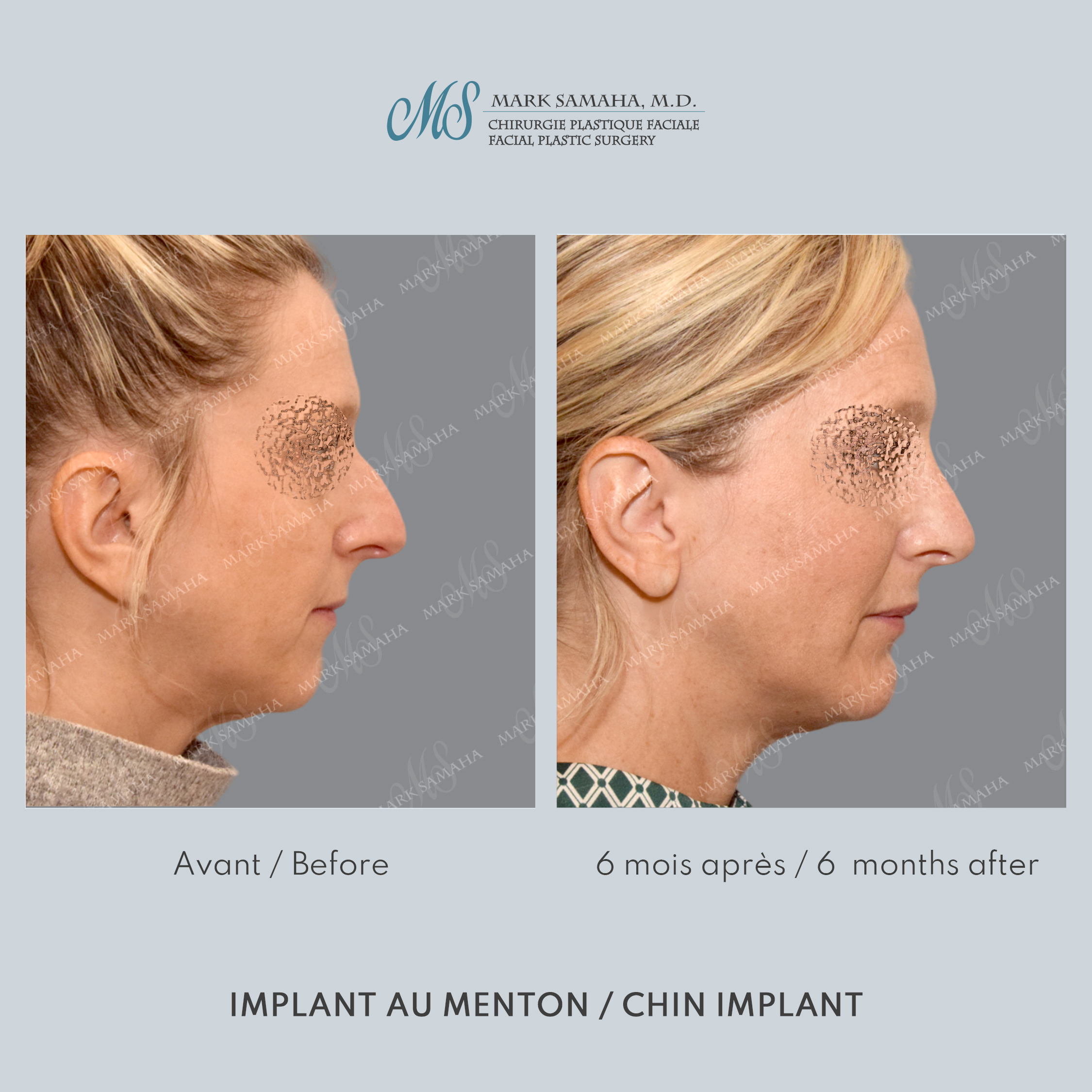 Before & After Augmentation du menton / Chin Augmentation Case 231 View #5 Detail View in Montreal, QC