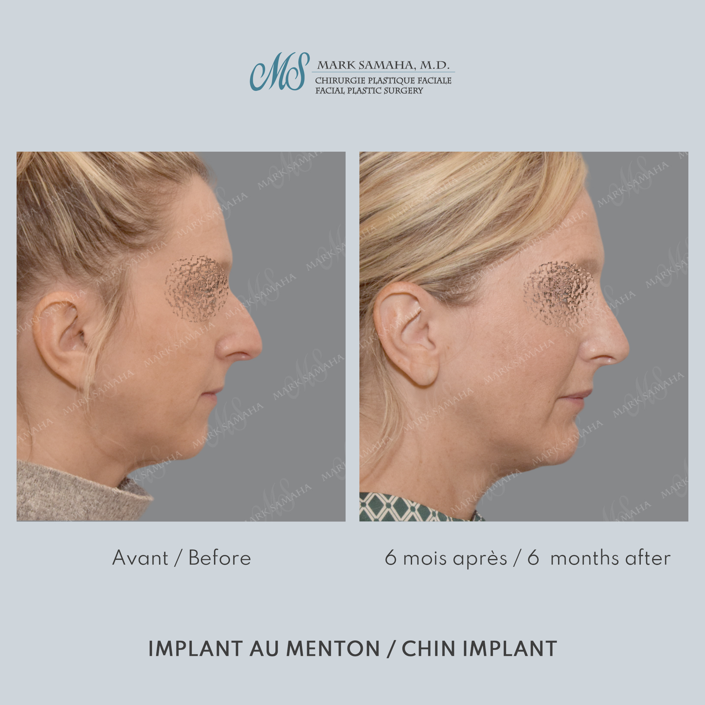 Before & After Augmentation du menton / Chin Augmentation Case 231 View #5 View in Montreal, QC