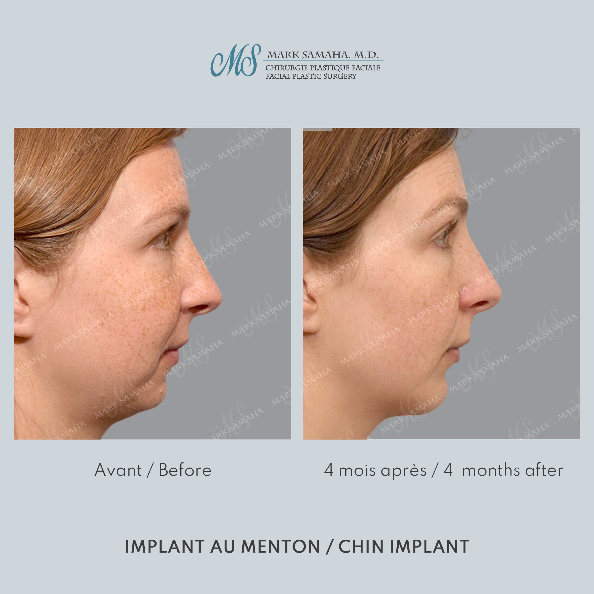 Before & After Augmentation du menton / Chin Augmentation Case 232 View #1 Detail View in Montreal, QC