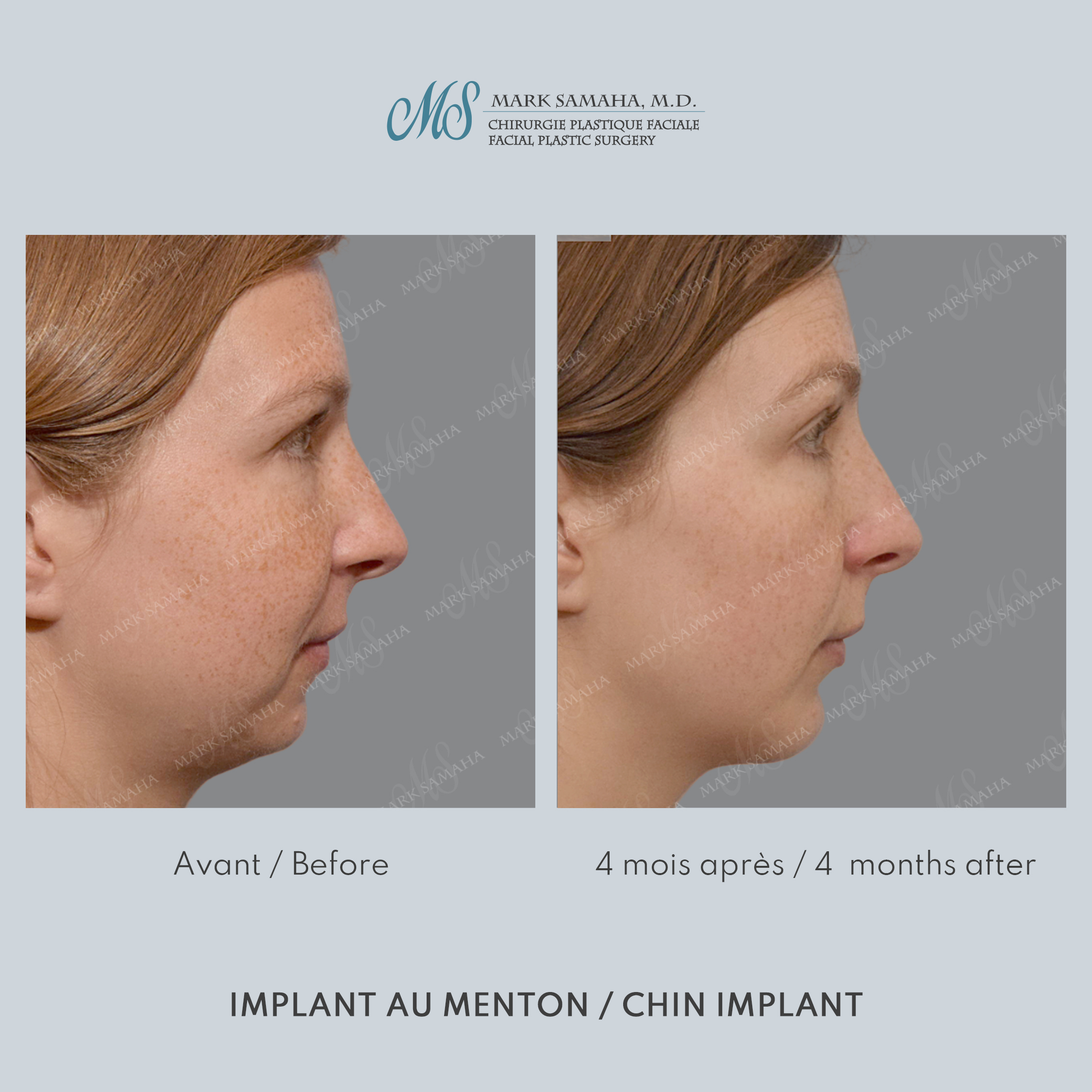 Before & After Augmentation du menton / Chin Augmentation Case 232 View #1 View in Montreal, QC