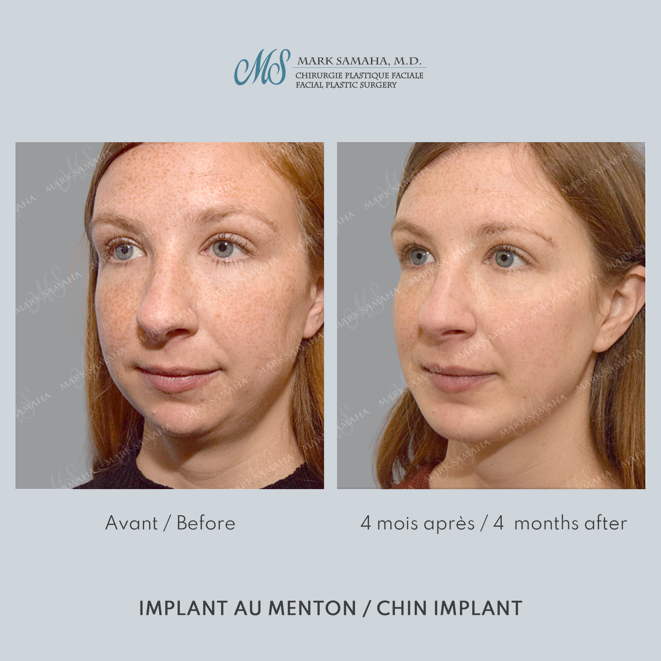 Before & After Augmentation du menton / Chin Augmentation Case 232 View #2 Detail View in Montreal, QC