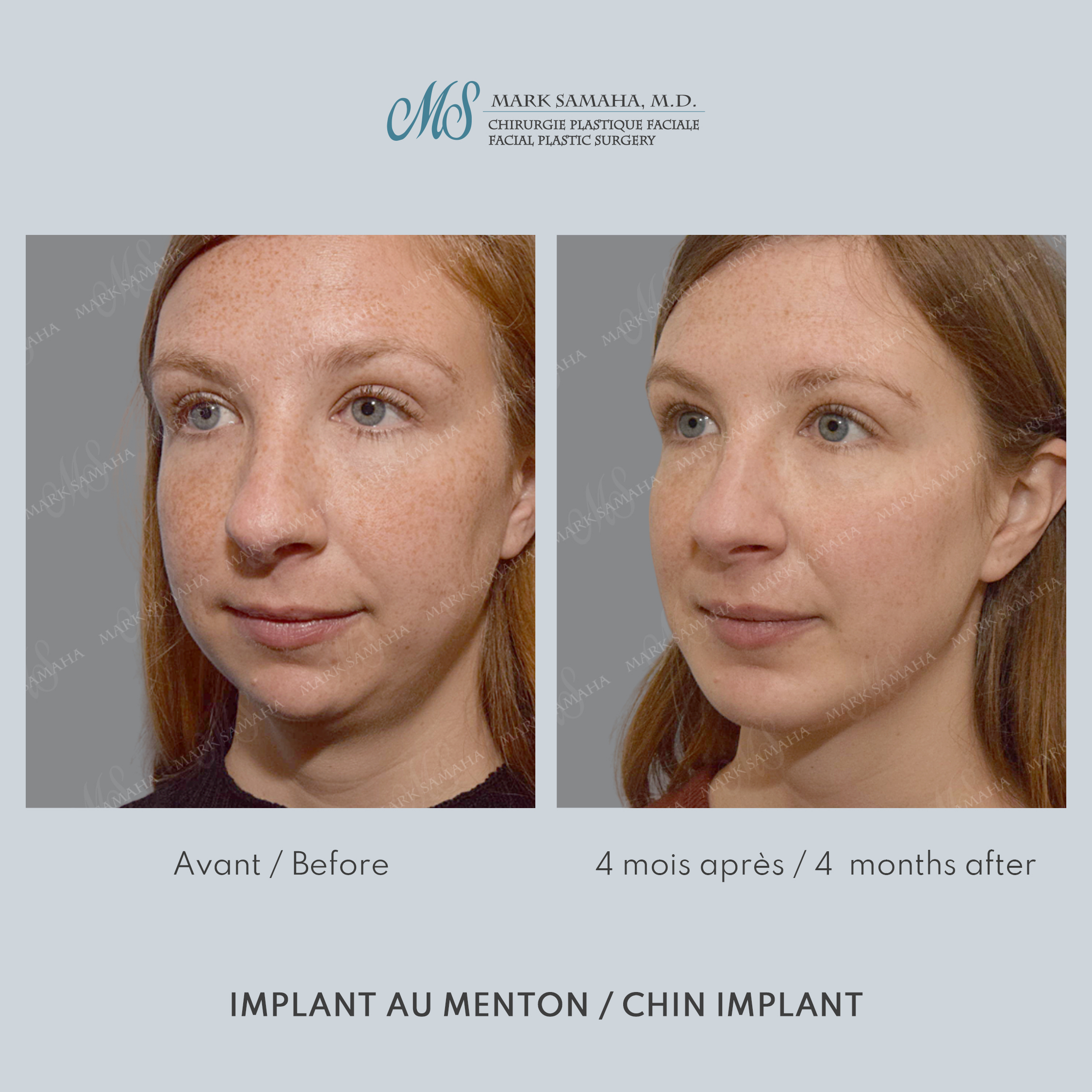 Before & After Augmentation du menton / Chin Augmentation Case 232 View #2 View in Montreal, QC