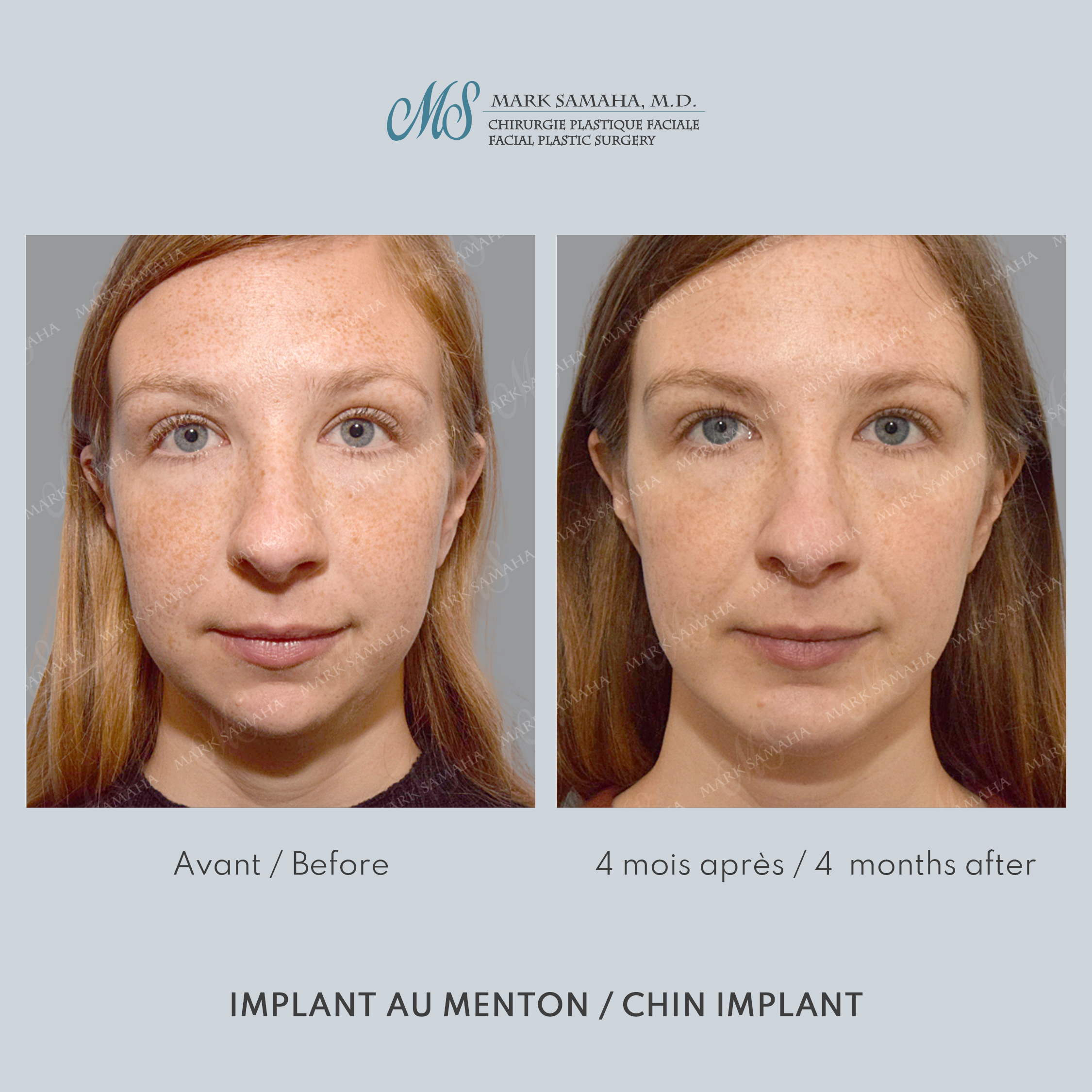 Before & After Augmentation du menton / Chin Augmentation Case 232 View #3 Detail View in Montreal, QC
