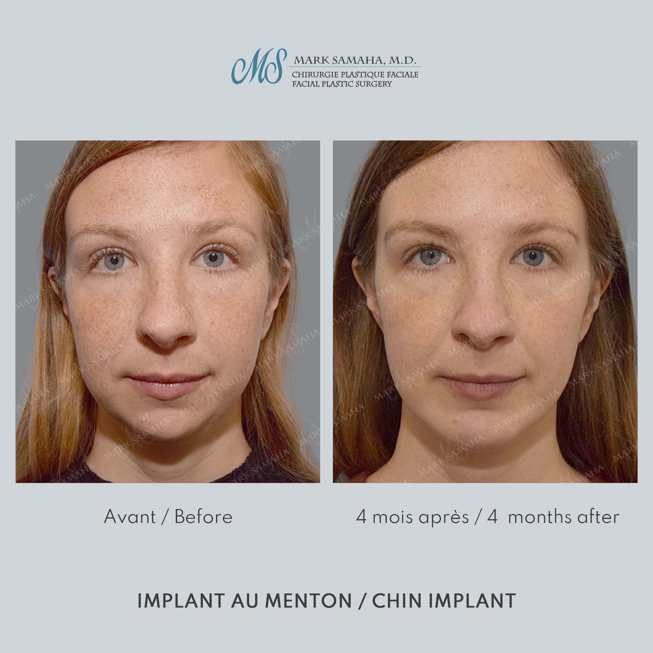 Before & After Augmentation du menton / Chin Augmentation Case 232 View #3 View in Montreal, QC