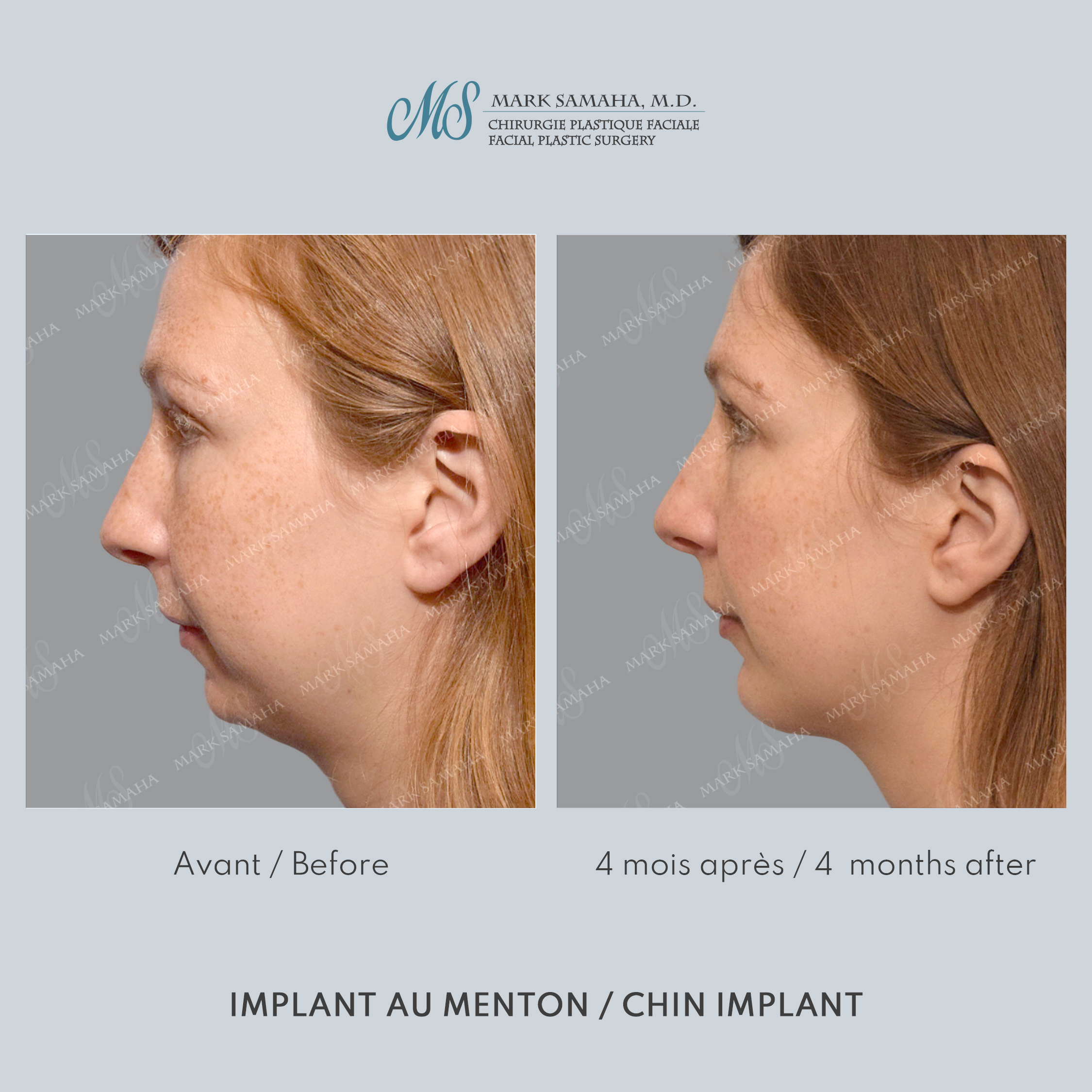 Before & After Augmentation du menton / Chin Augmentation Case 232 View #4 Detail View in Montreal, QC